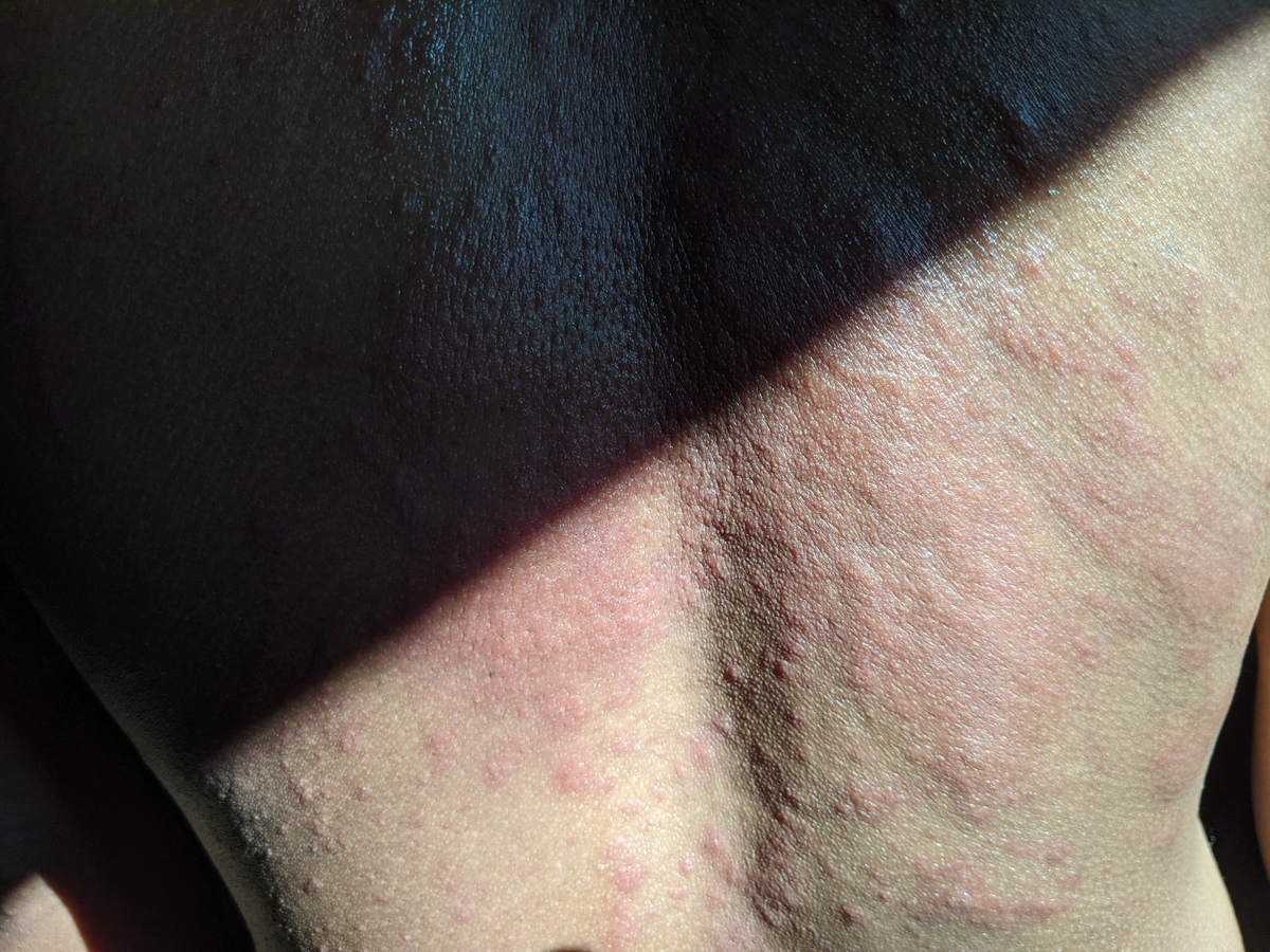 阳光过敏怎么办？预防措施及应对方法