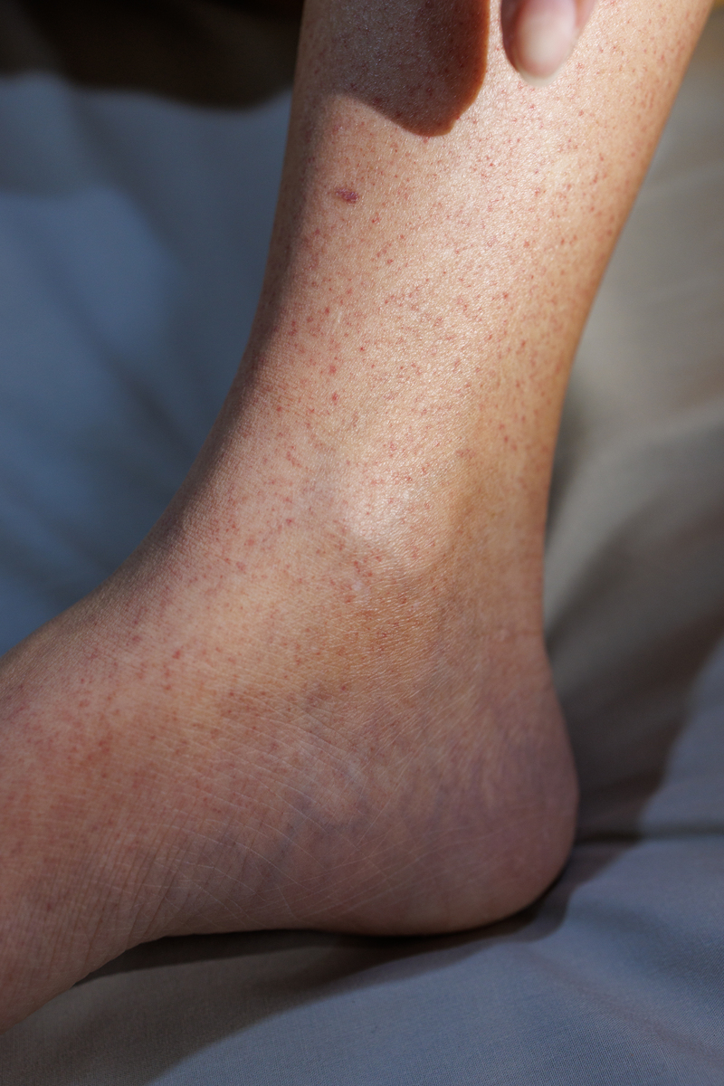 干燥蜕皮、瘙痒疼痛、渗出液体？可能是湿疹或皮炎！