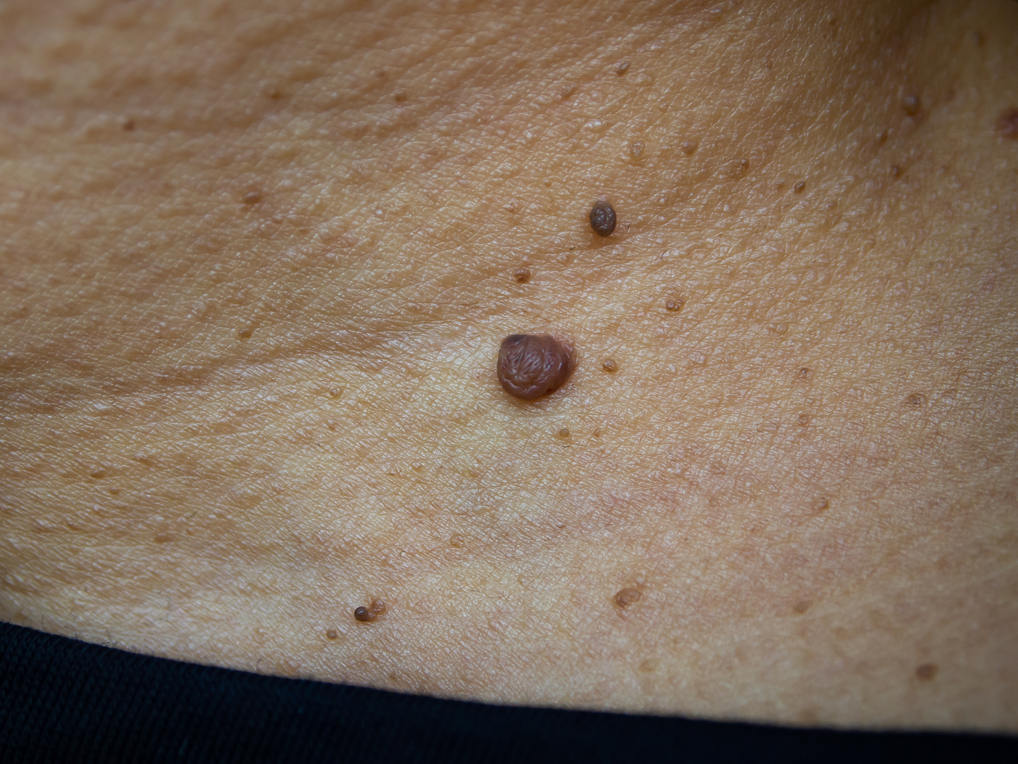 brown moles on woman's neck, medicine, close up & macro shot, se