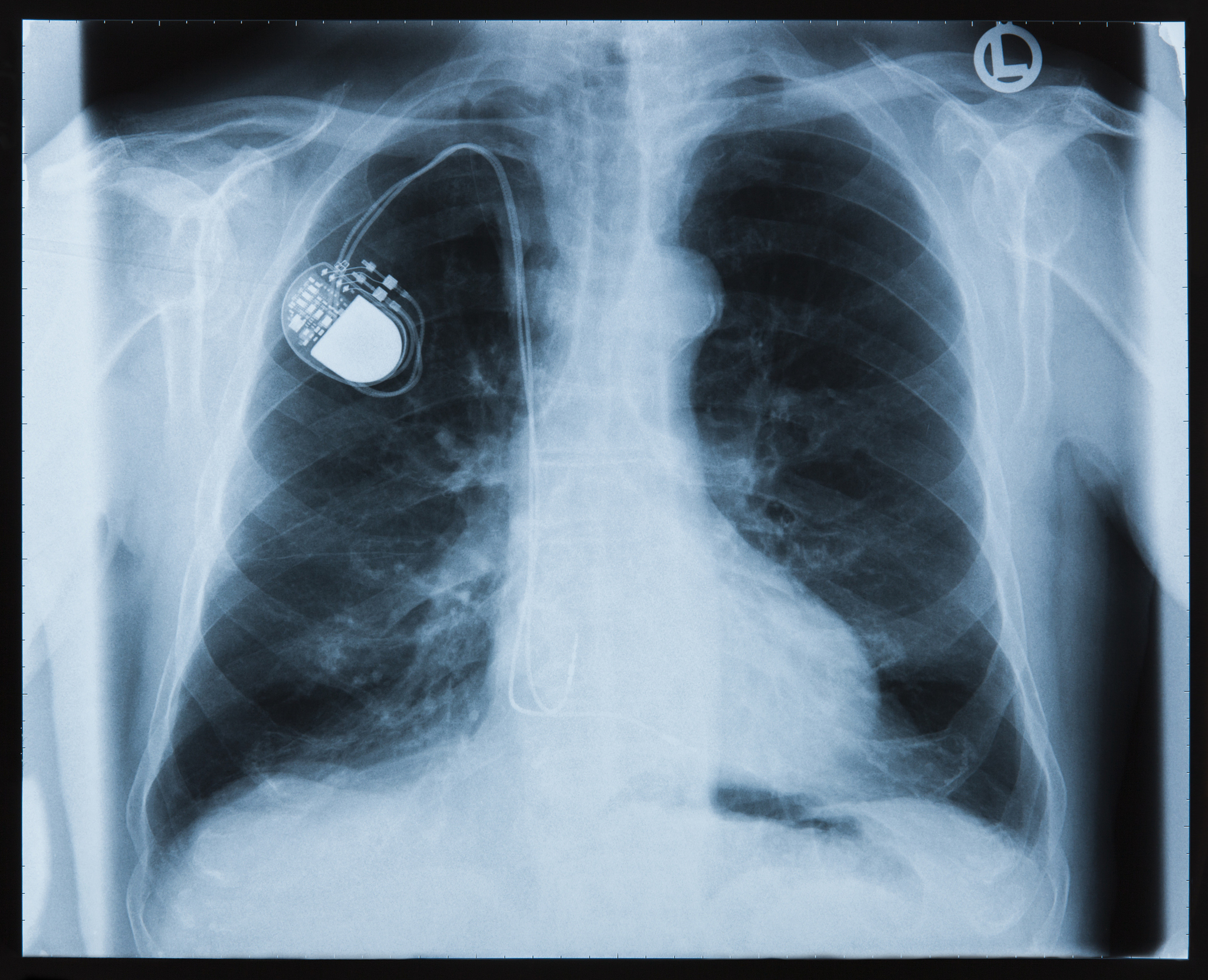 在进行心脏起搏器植入手术前应该明确哪些检查注意哪些问题