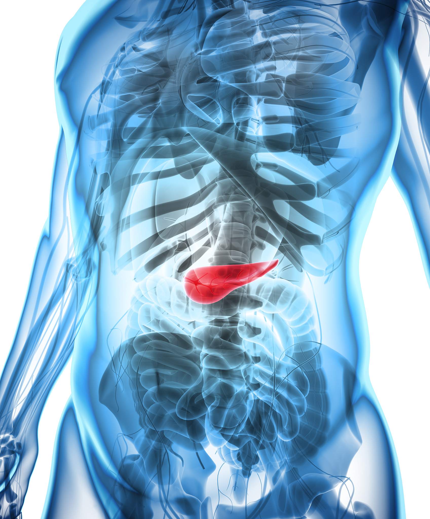 患者男45岁因皮肤巩膜黄染1周入院患者入院前1周无明显诱因出现皮肤巩膜黄染伴有皮肤轻度瘙痒无明显腹痛腹胀无畏寒发热院外超声及CT均提示胰头部占位考虑胰腺癌入院后进一步磁共振检查提示胰头直径约2cm大小实性占位伴胆总管扩张、梗阻与周围血管关系不大实验室检查提示胆红素稍高CA199明显升高。入院诊断为胰腺癌考虑为可切除性。外科手术是目前治疗胰腺肿瘤最常用和最主要的手段但行传统开腹以胰十二指肠切除术还是