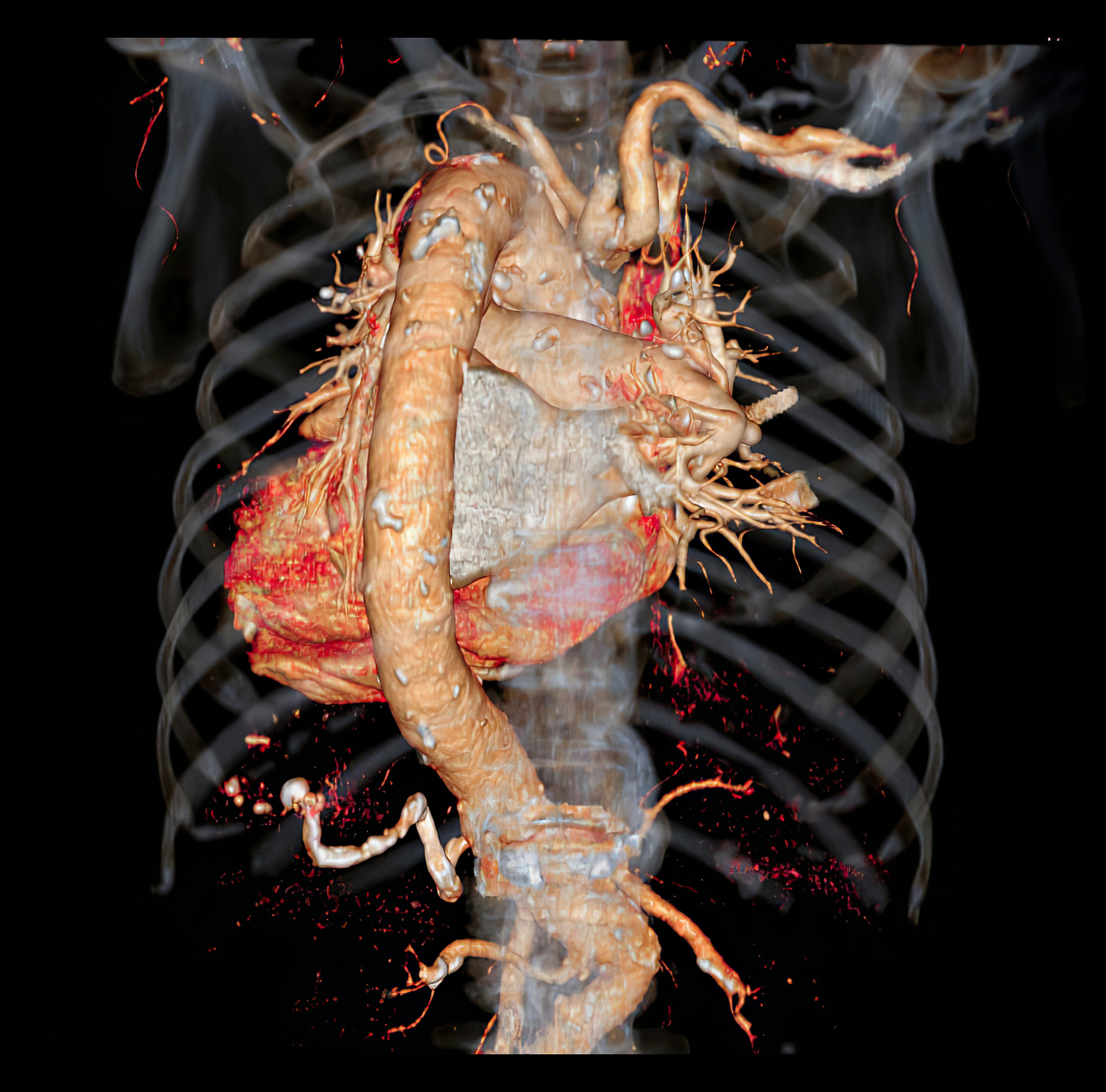 Contrast-Enhanced Ultrasound: Advantages for Plaque Imaging