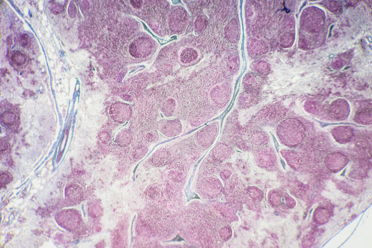 肠癌远处转移（M）是1是什么意思？