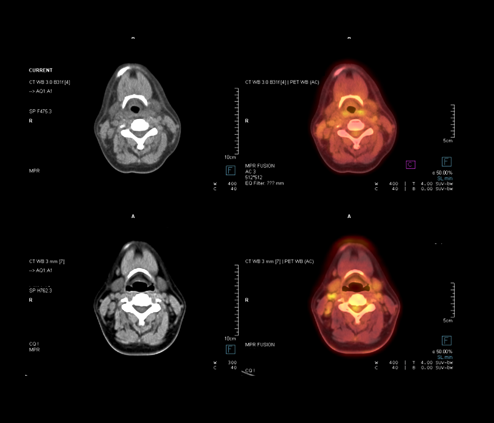 甲状腺癌手术指南：术前准备、术后护理及康复全解析