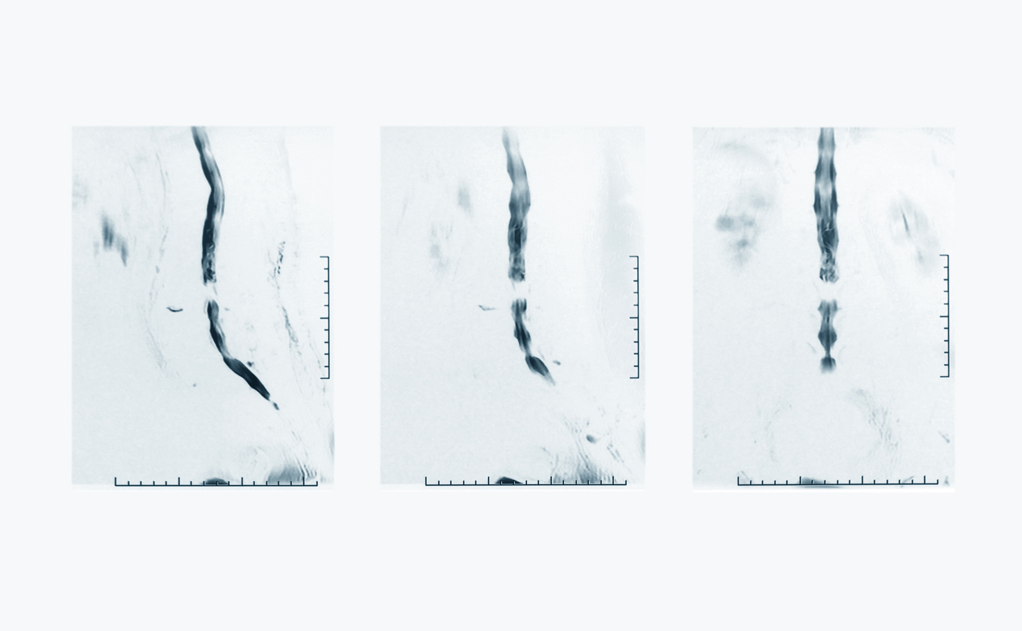 椎体成形术PVP的相对禁忌症：哪些患者不适合？