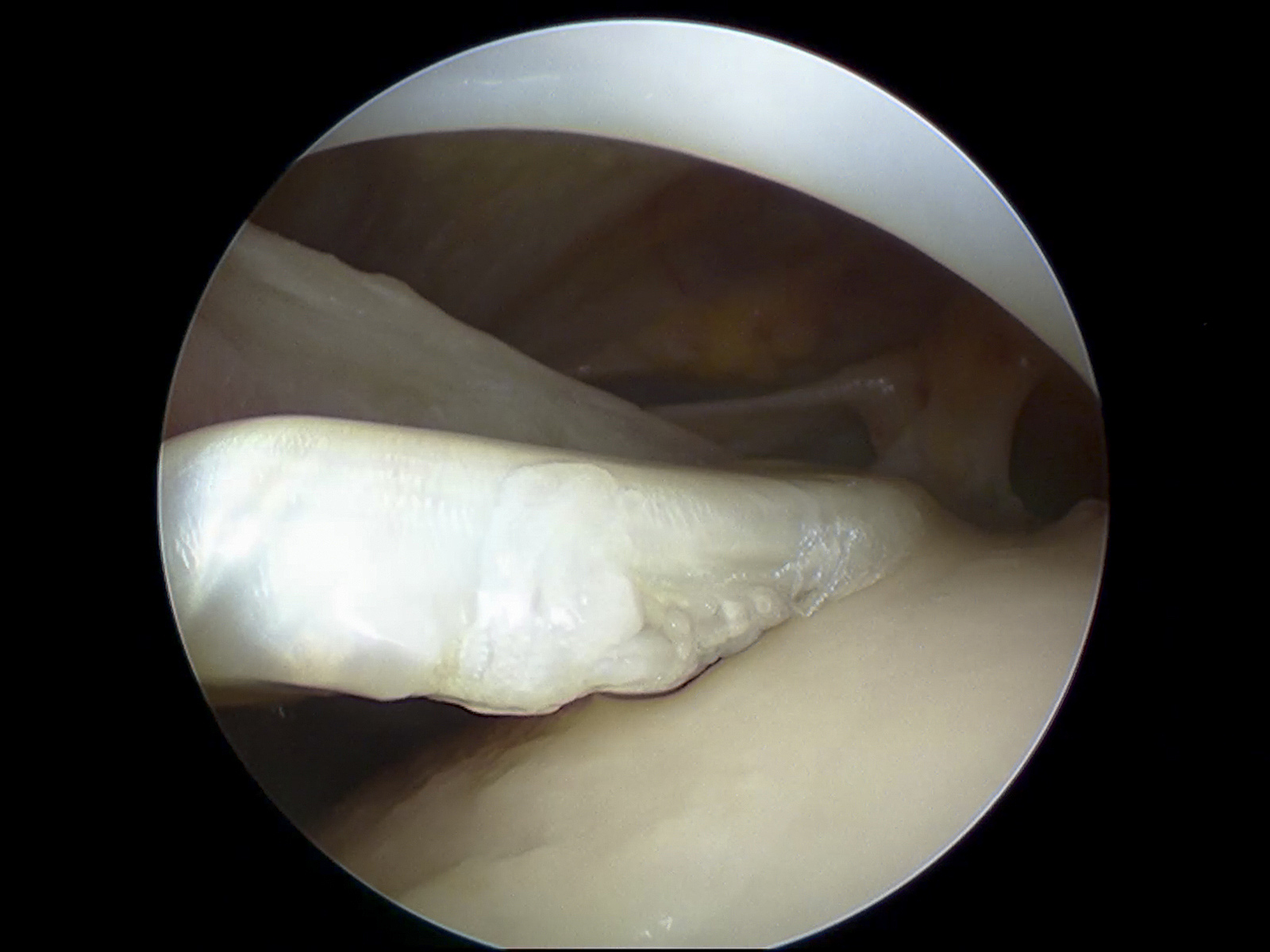 肩部肌腱炎：哪些肌腱受累？