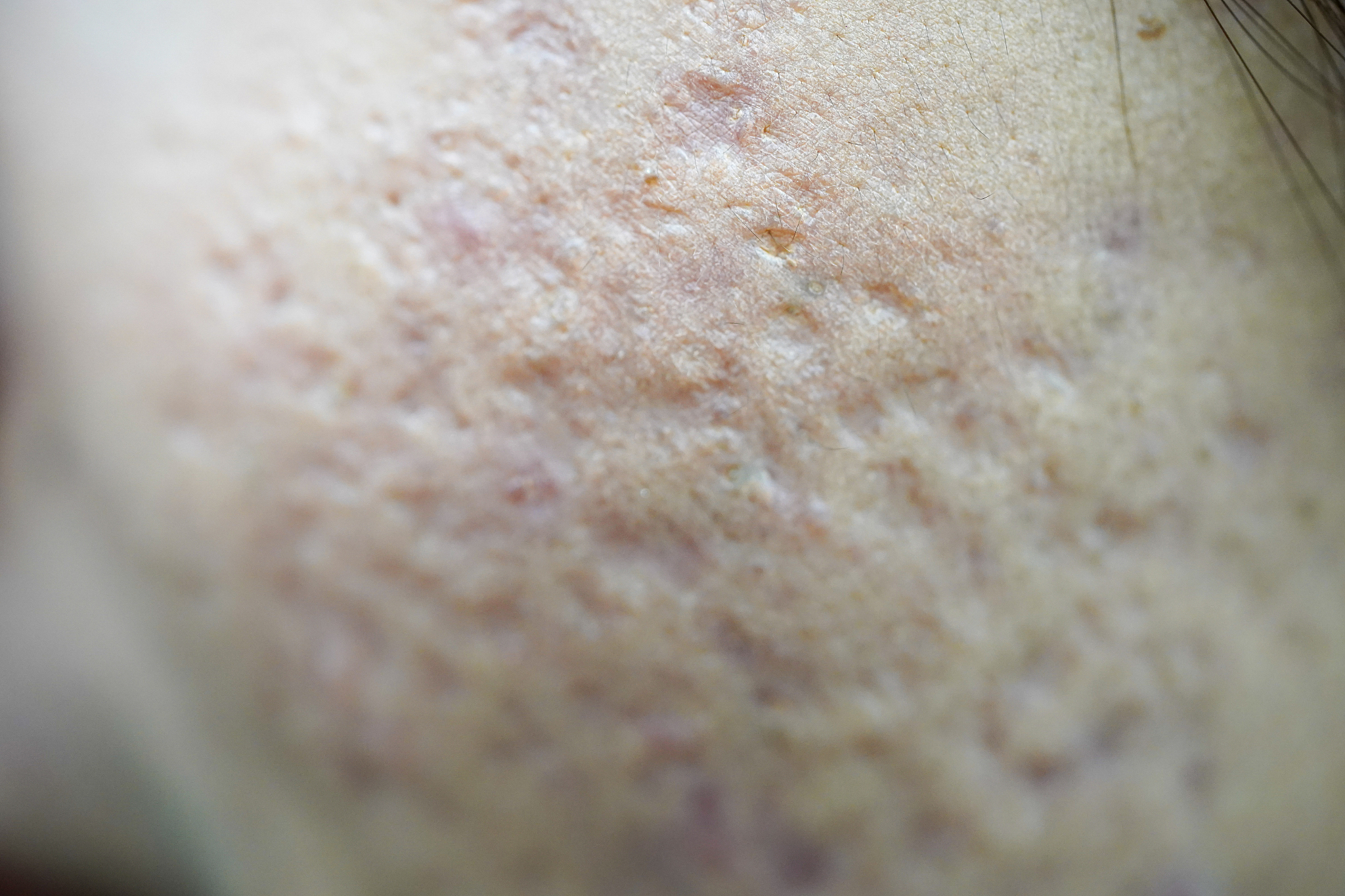 problematic skin with deep acne scars on cheek. concepts of beau