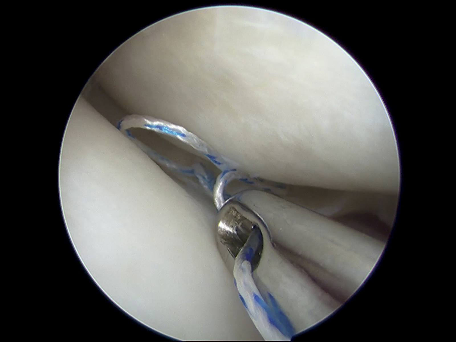 关节镜技术修复距腓前韧带：微创、高效、恢复快