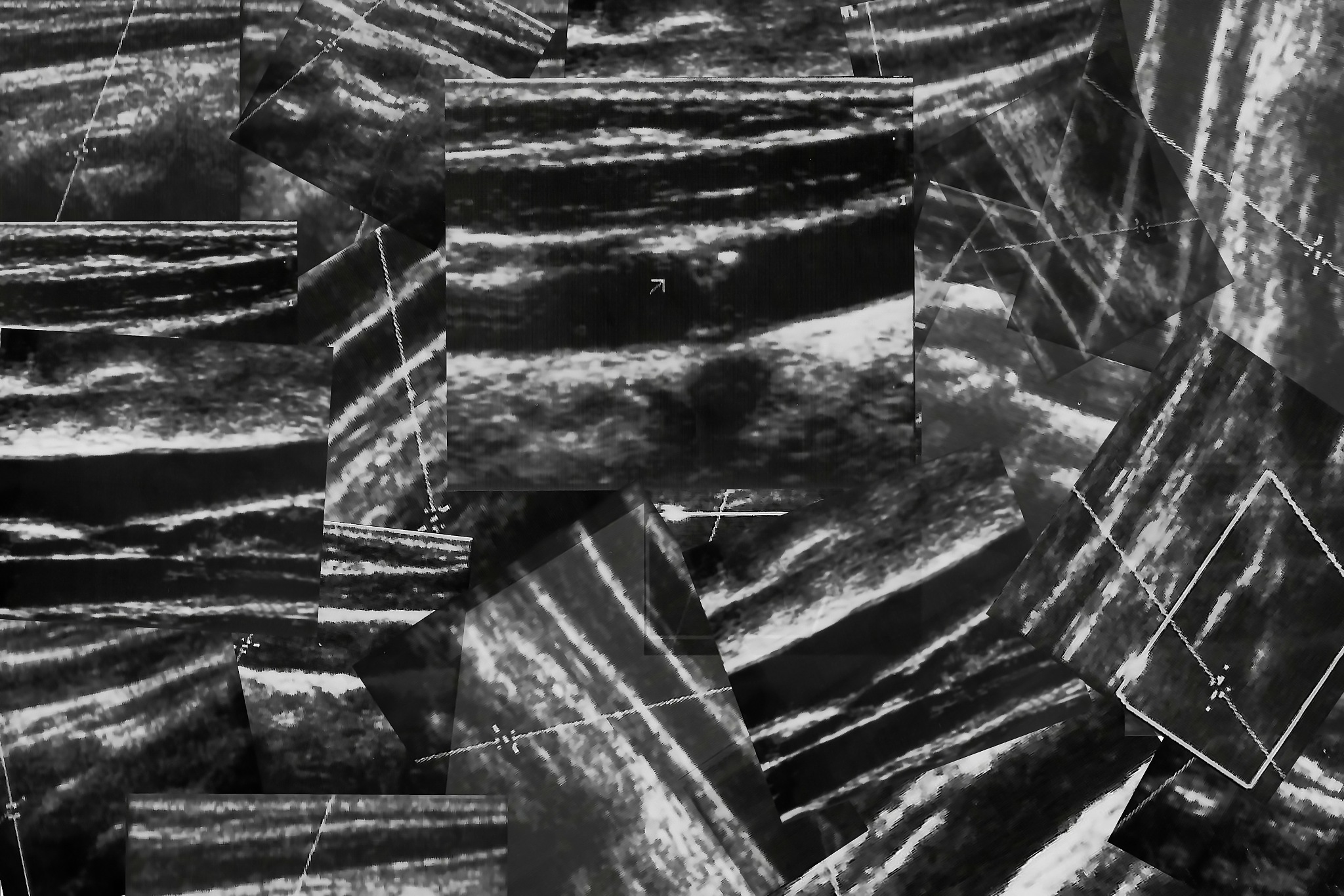 宝宝右锁骨下动脉迷走怎么办？产科医生解答