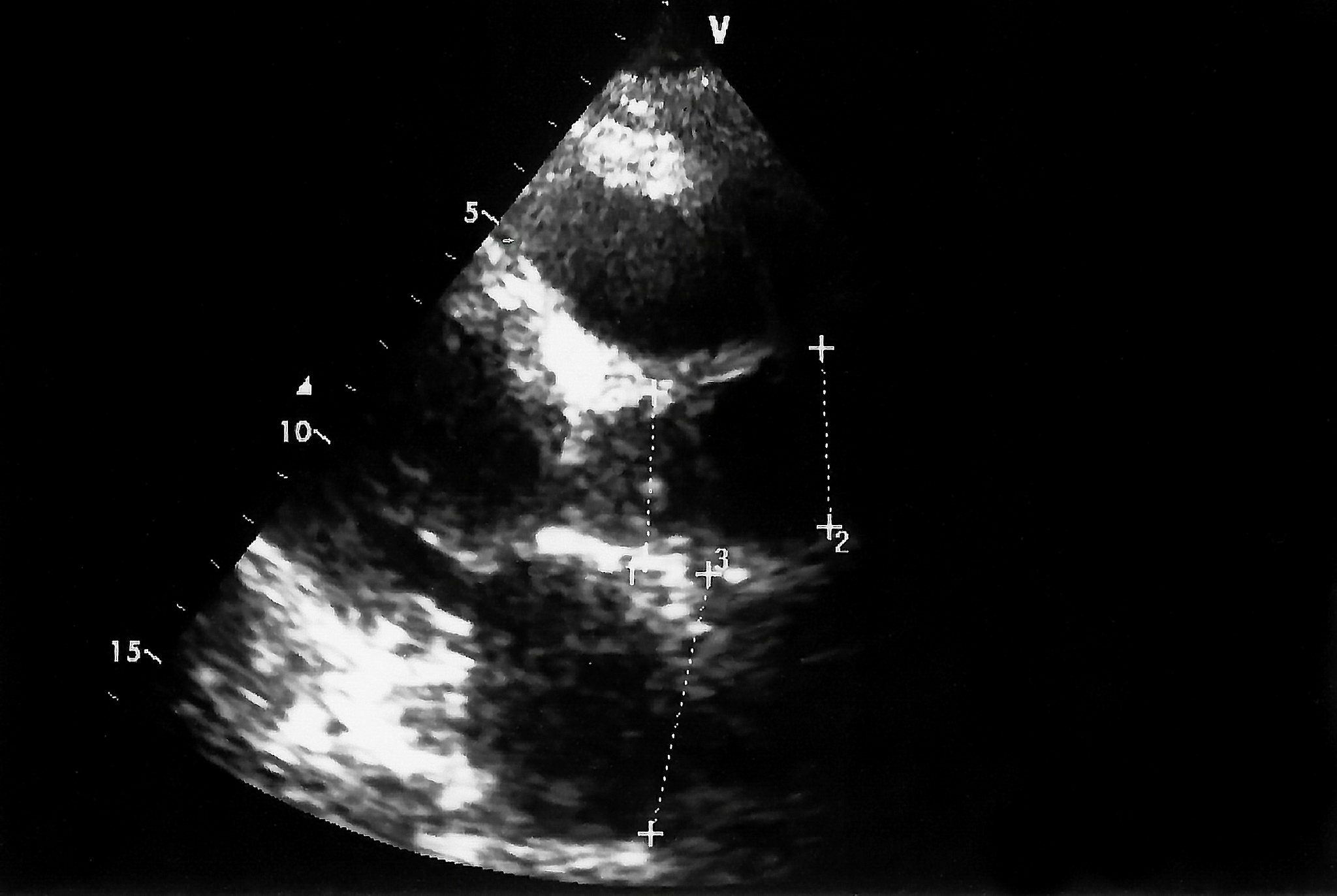 cardiac ultrasound images . doppler echo