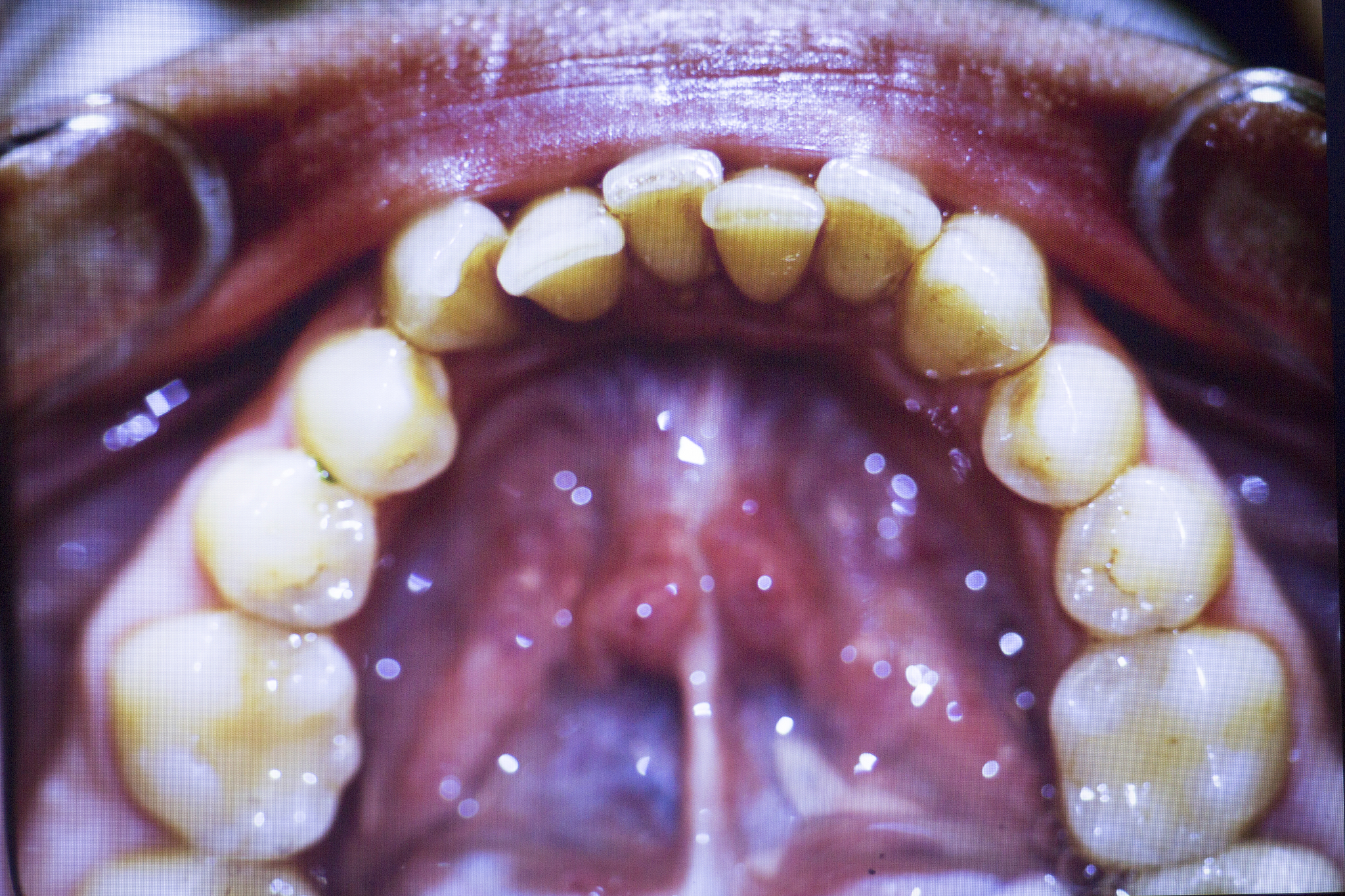 蛀牙严重时会怎样？