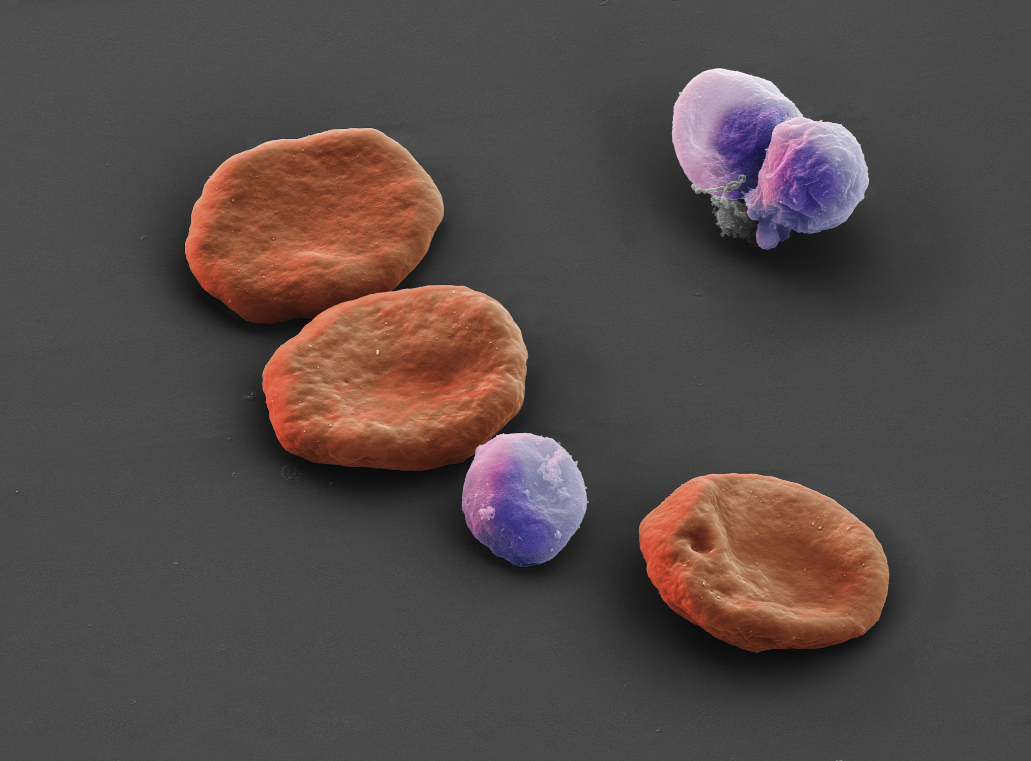 异常红细胞形态检测的临床意义及检测方法