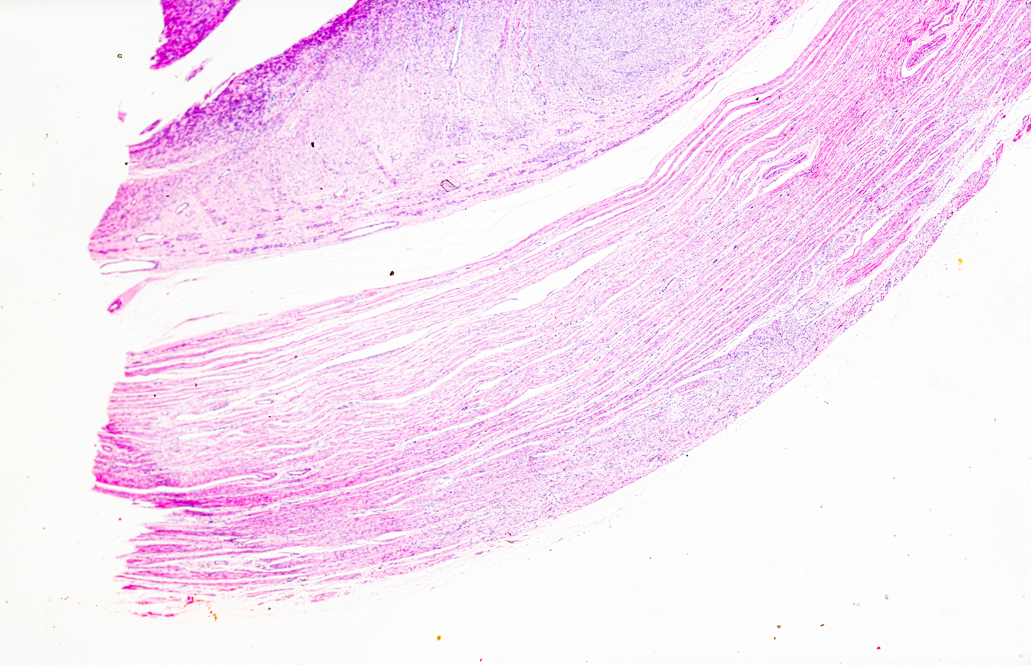 子宫平滑肌瘤是什么？症状、治疗方法及就医建议