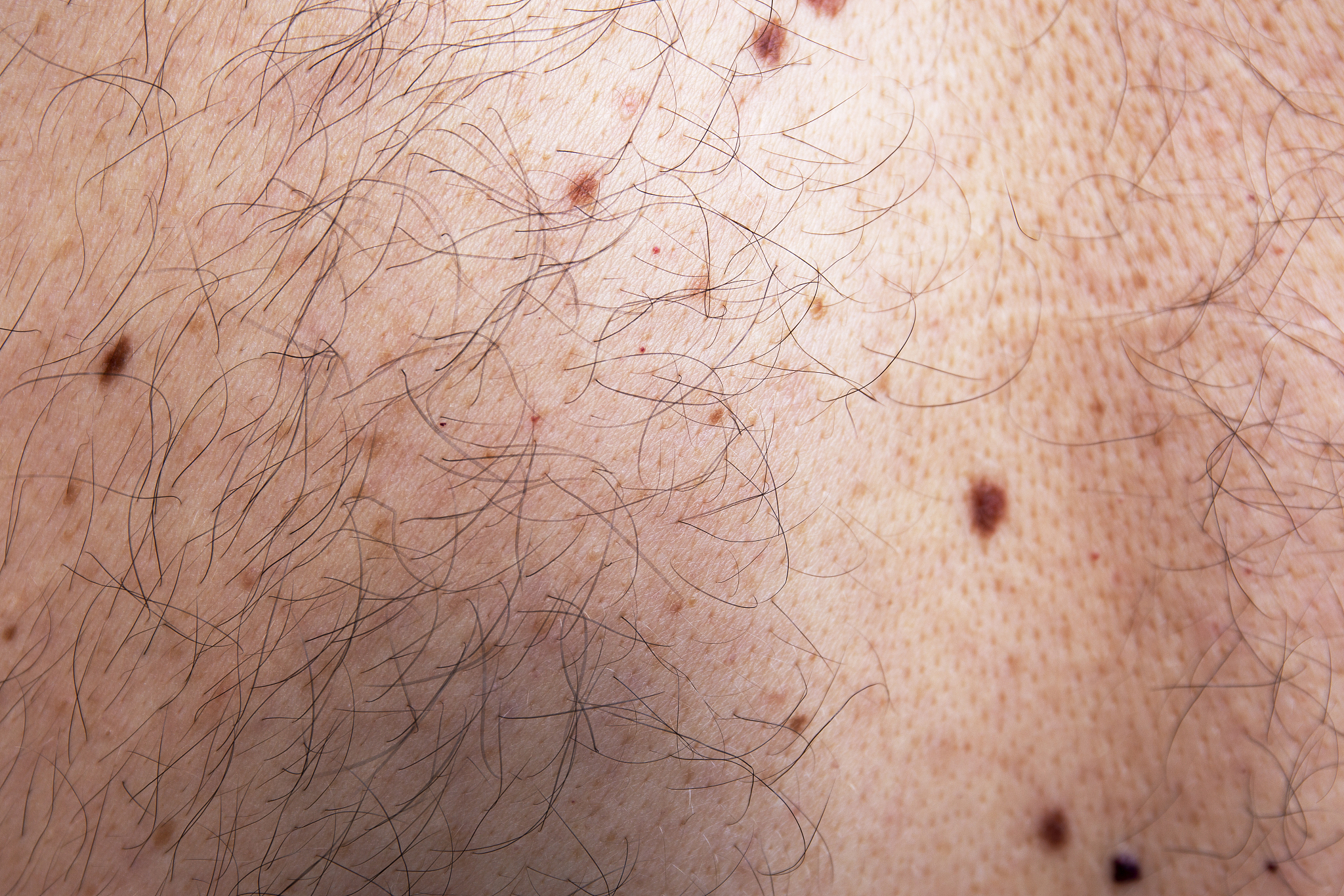 skin disease on caucasian man bust