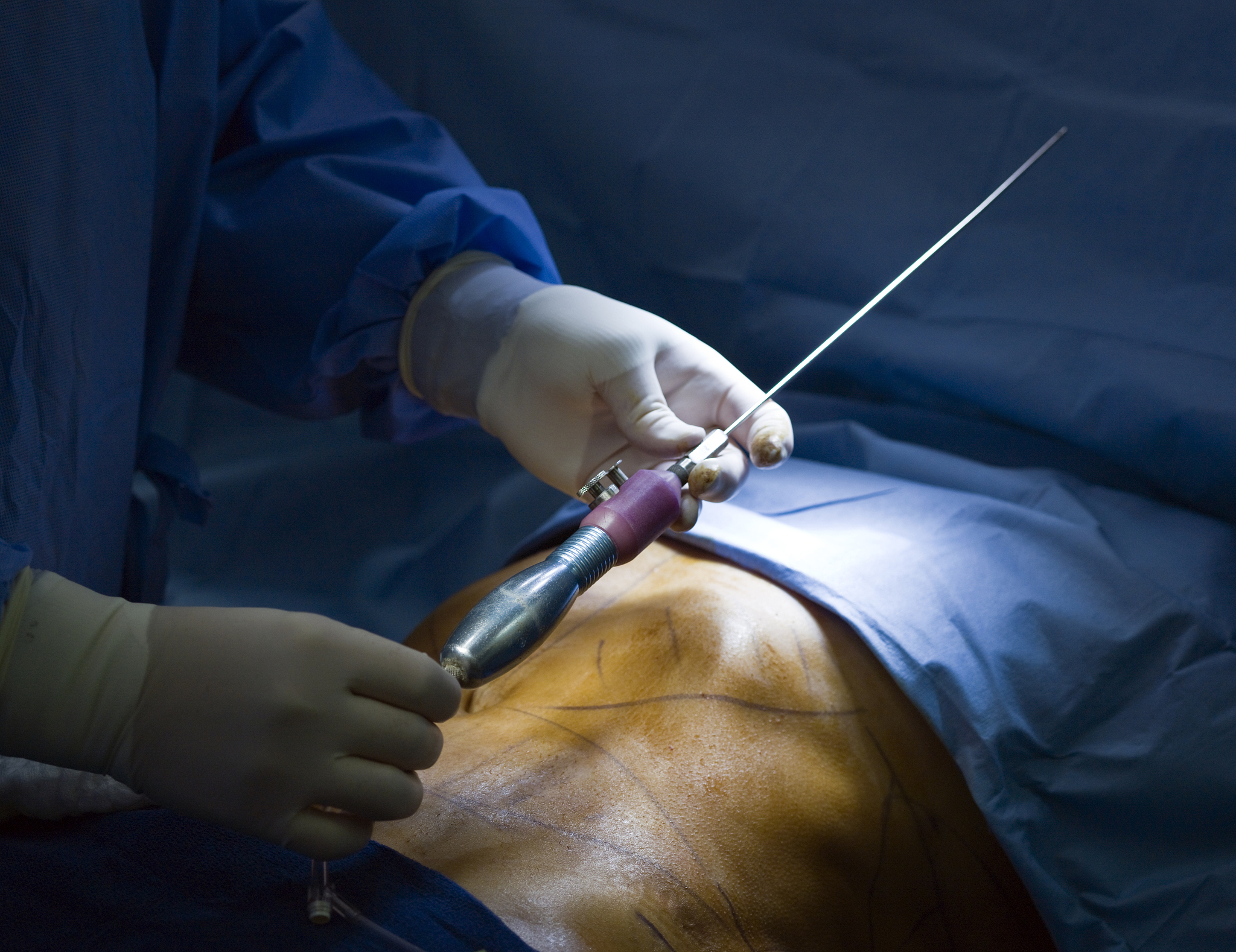 男性结扎后可以恢复生育吗？