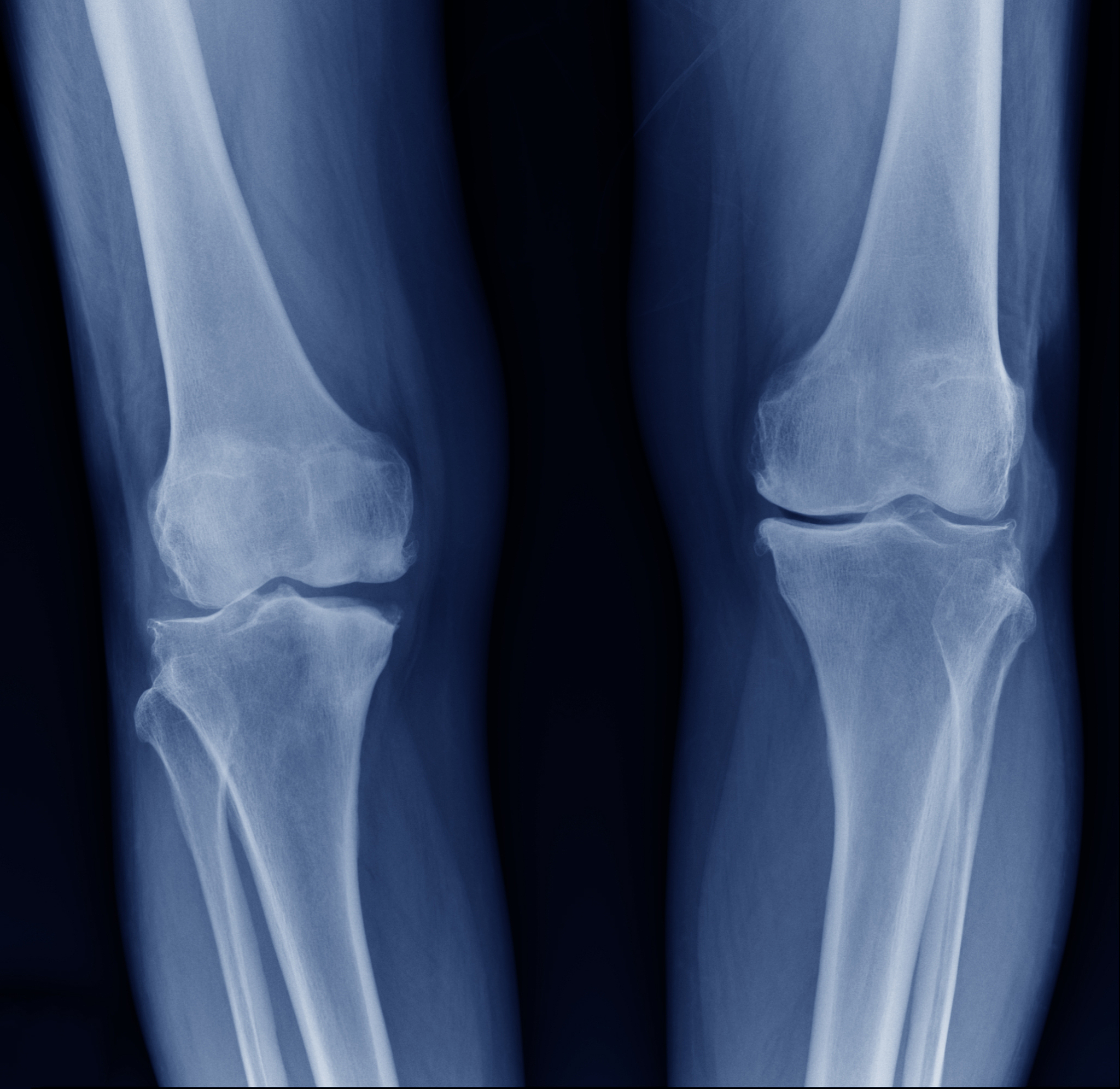 后外侧塌陷胫骨平台骨折：现状分析及治疗