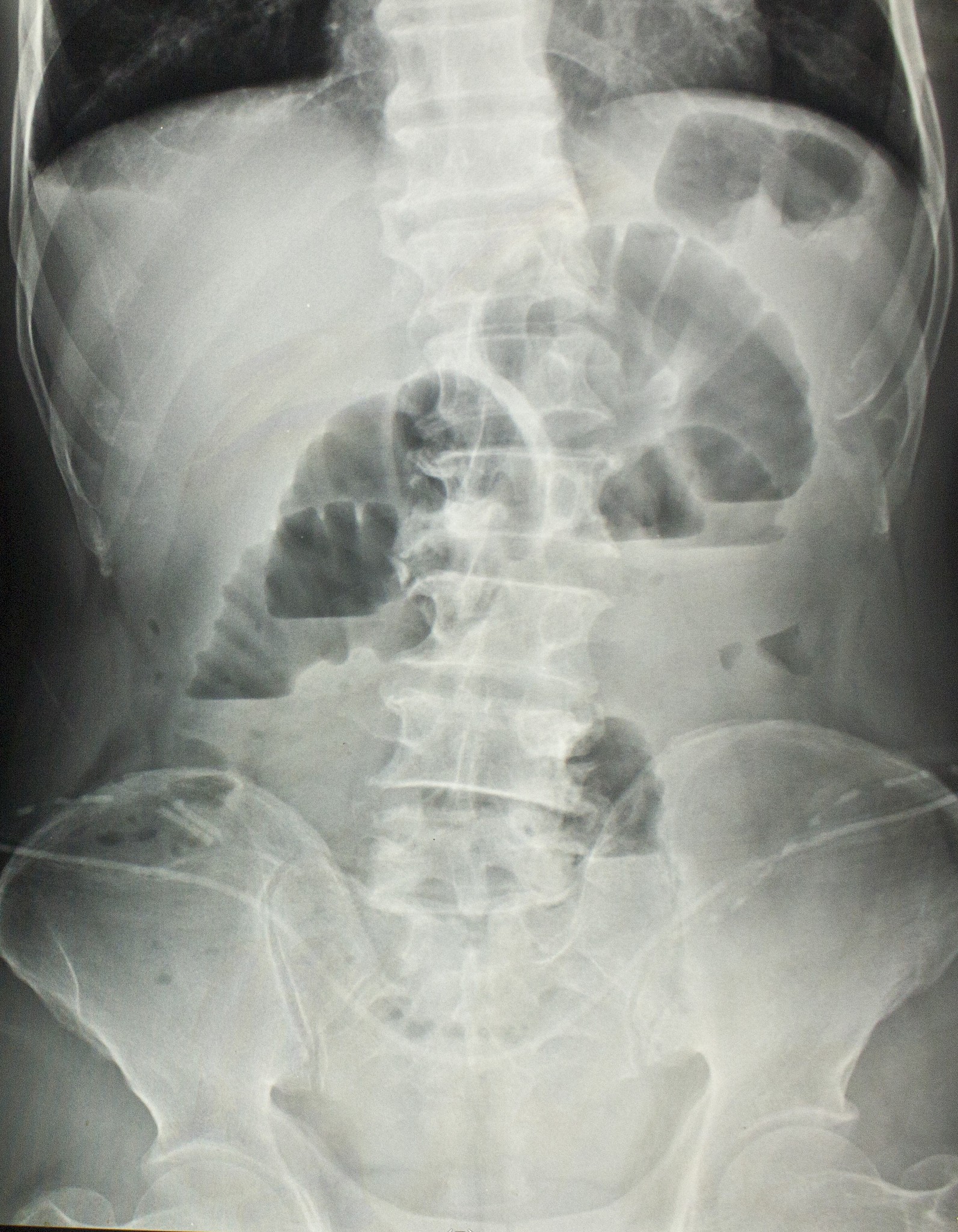 钡餐检查的副作用：常见问题及注意事项