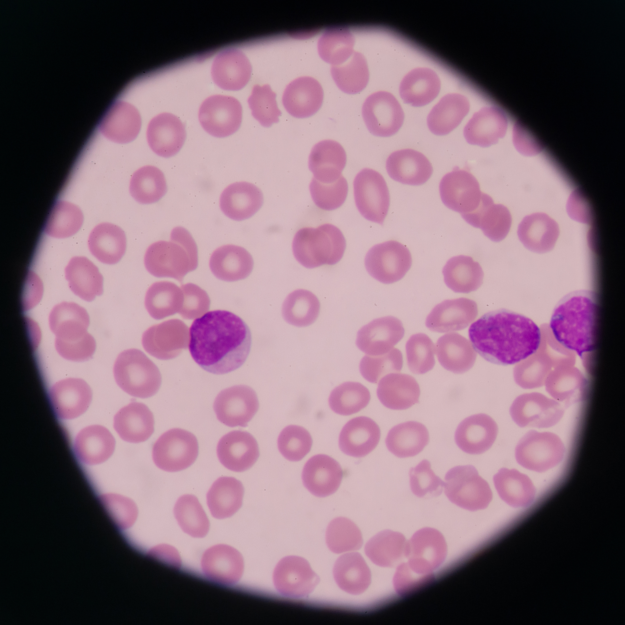 blast cells in peripheral blood images.