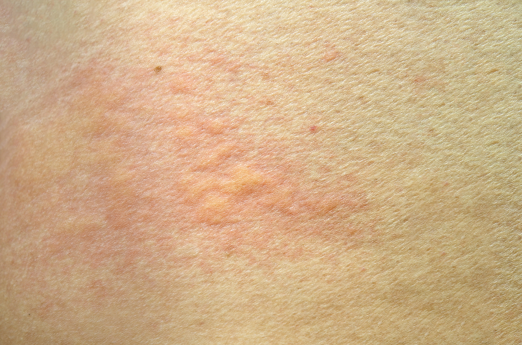 skin rash, urticaria, allergic skin reaction.