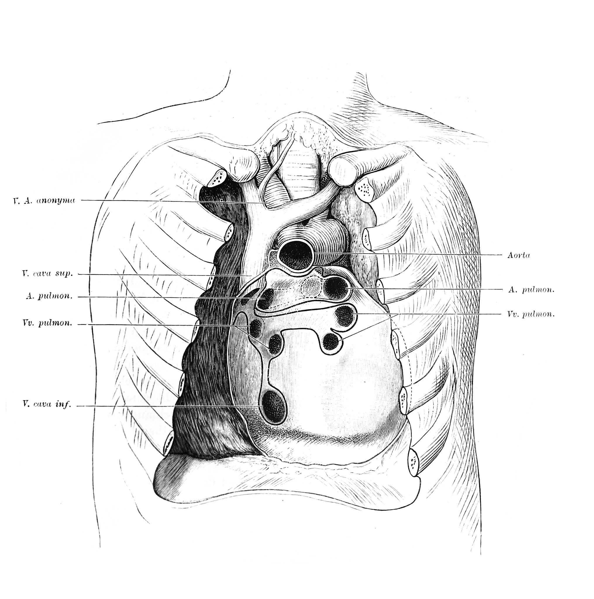 胸膜粘连带翻译：Pleural Adhesions