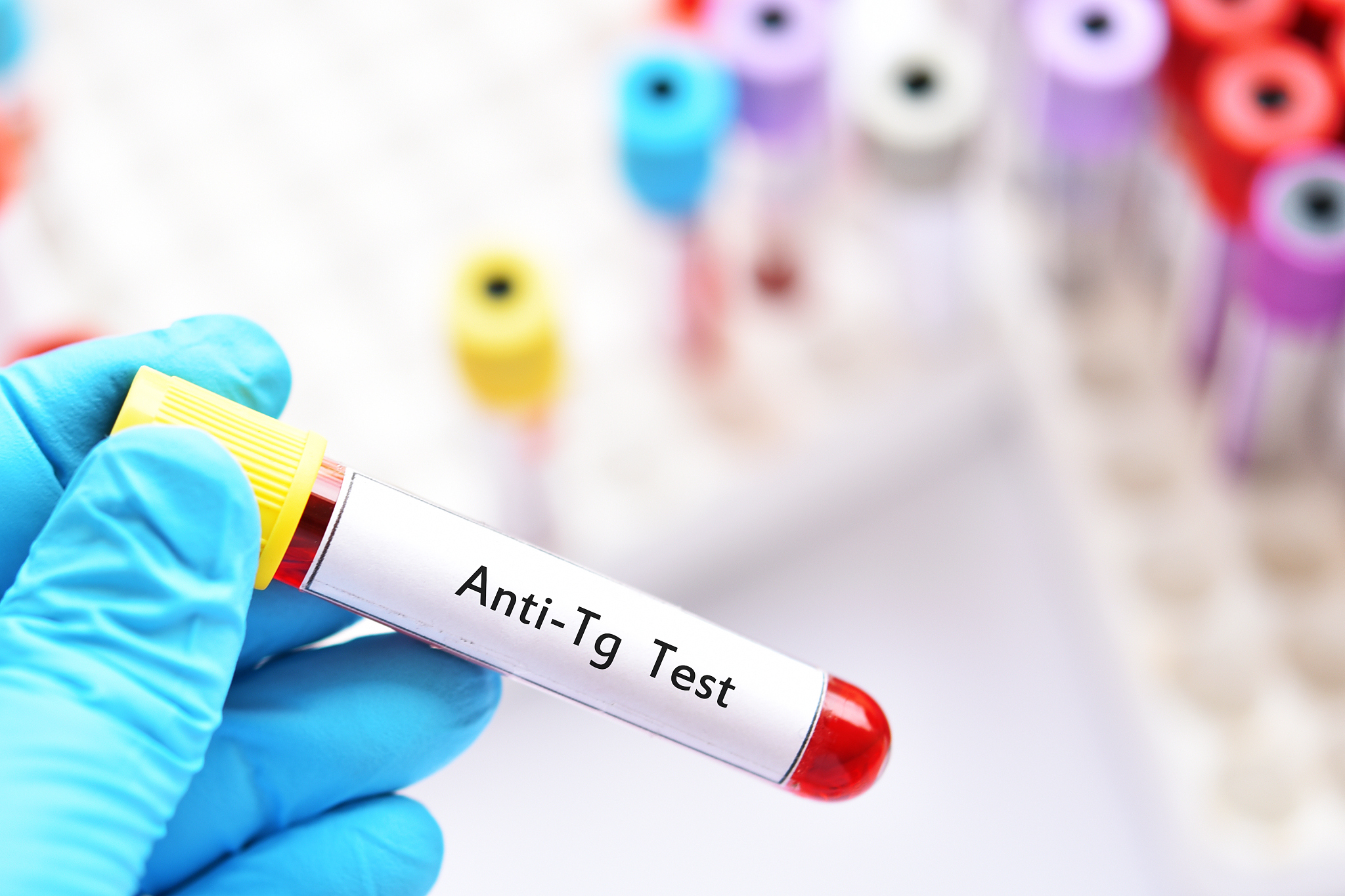 碘缺乏症的症状：甲状腺肿、代谢减慢等