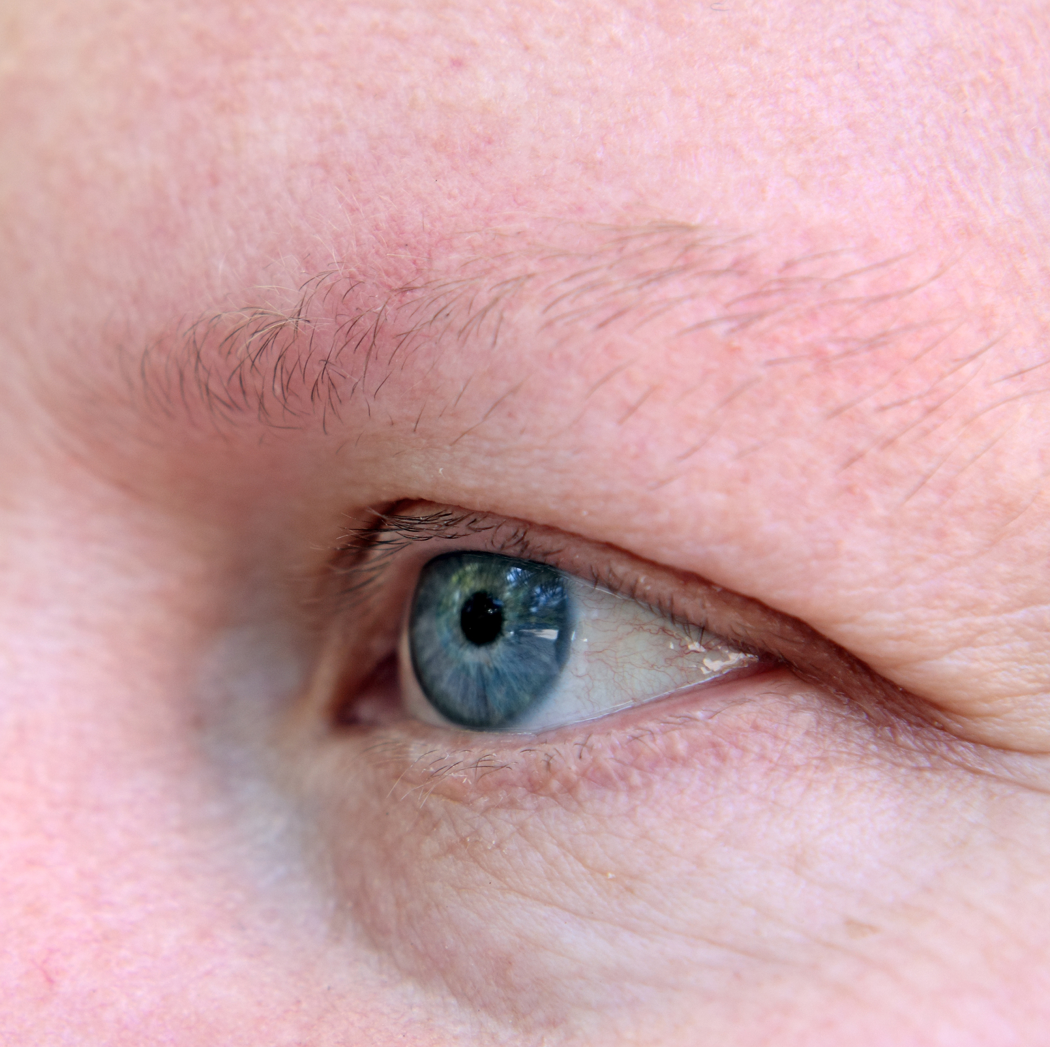 针灸治疗眼睑痉挛: 安全有效的缓解方法