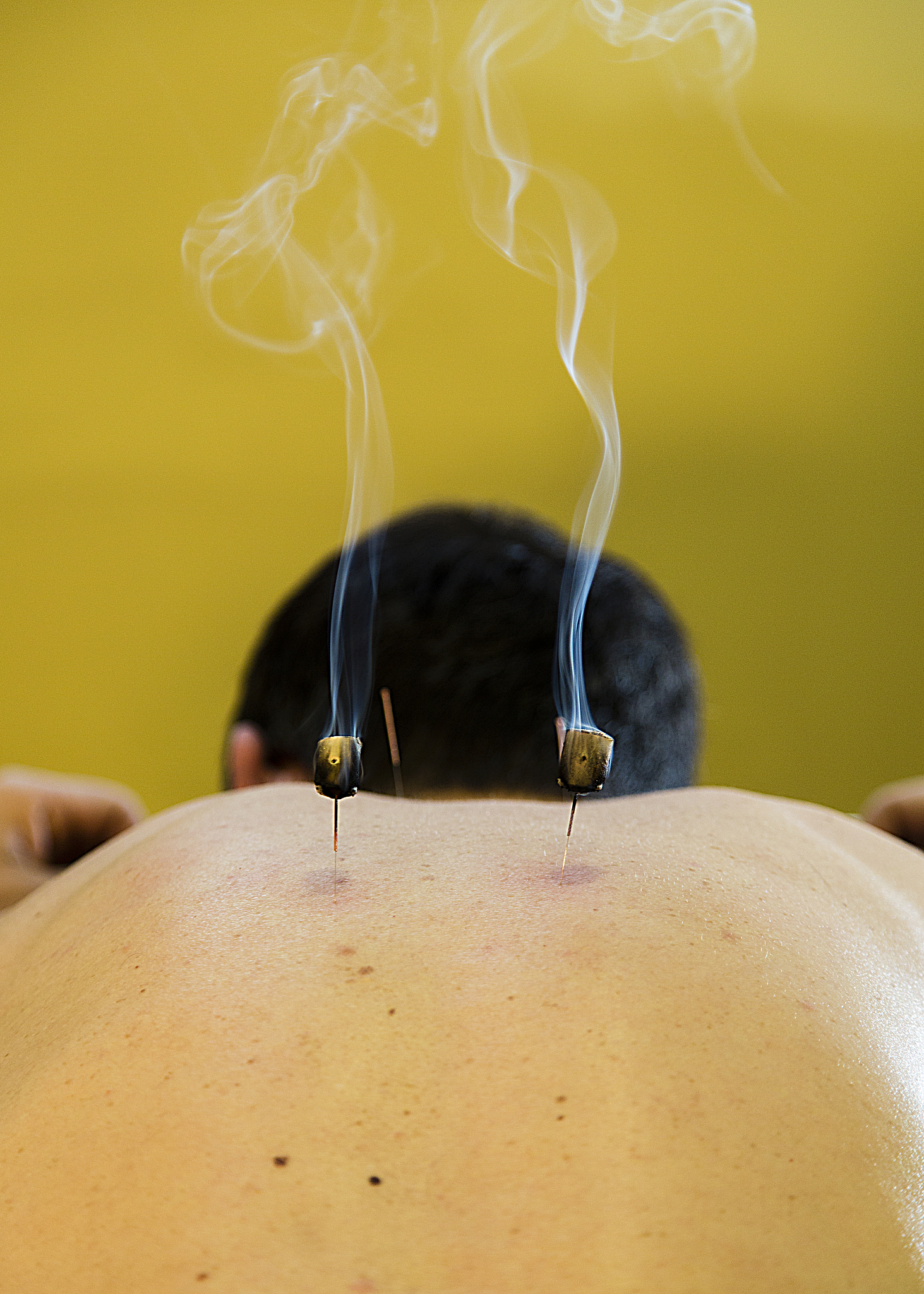 person receiving an acupuncture treatment.