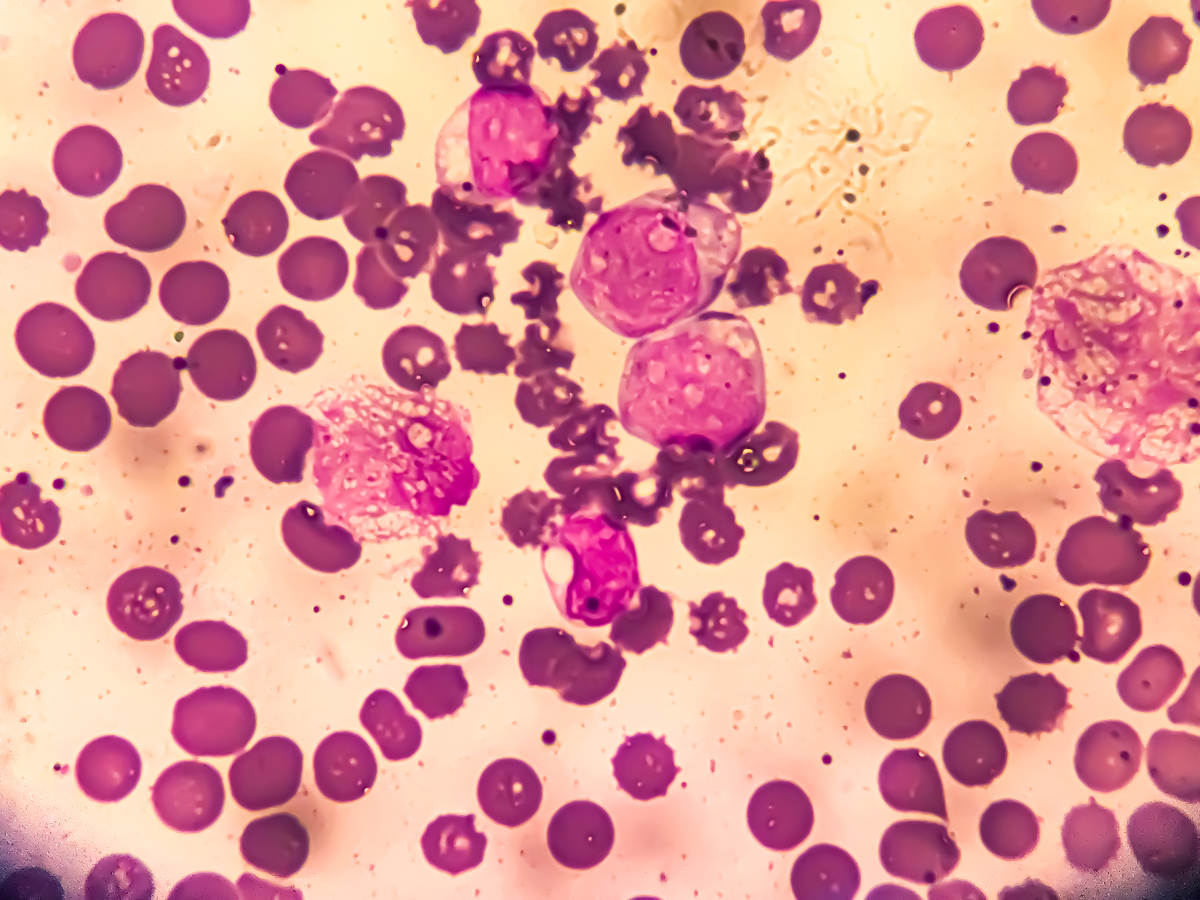 人共生菌致病性强有哪些？常见致病菌及感染类型详解