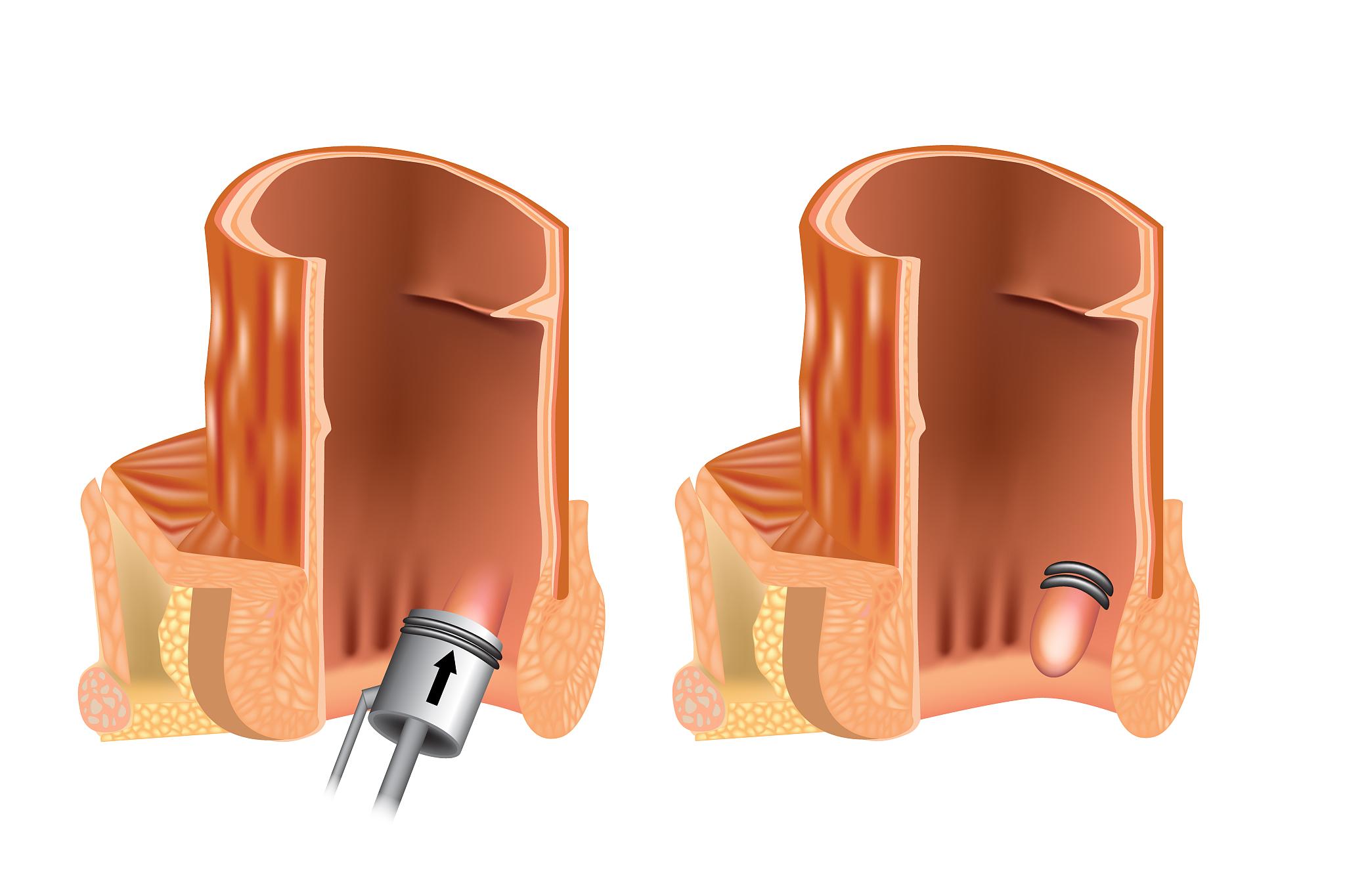 rubber band ligation of hemorrhoid