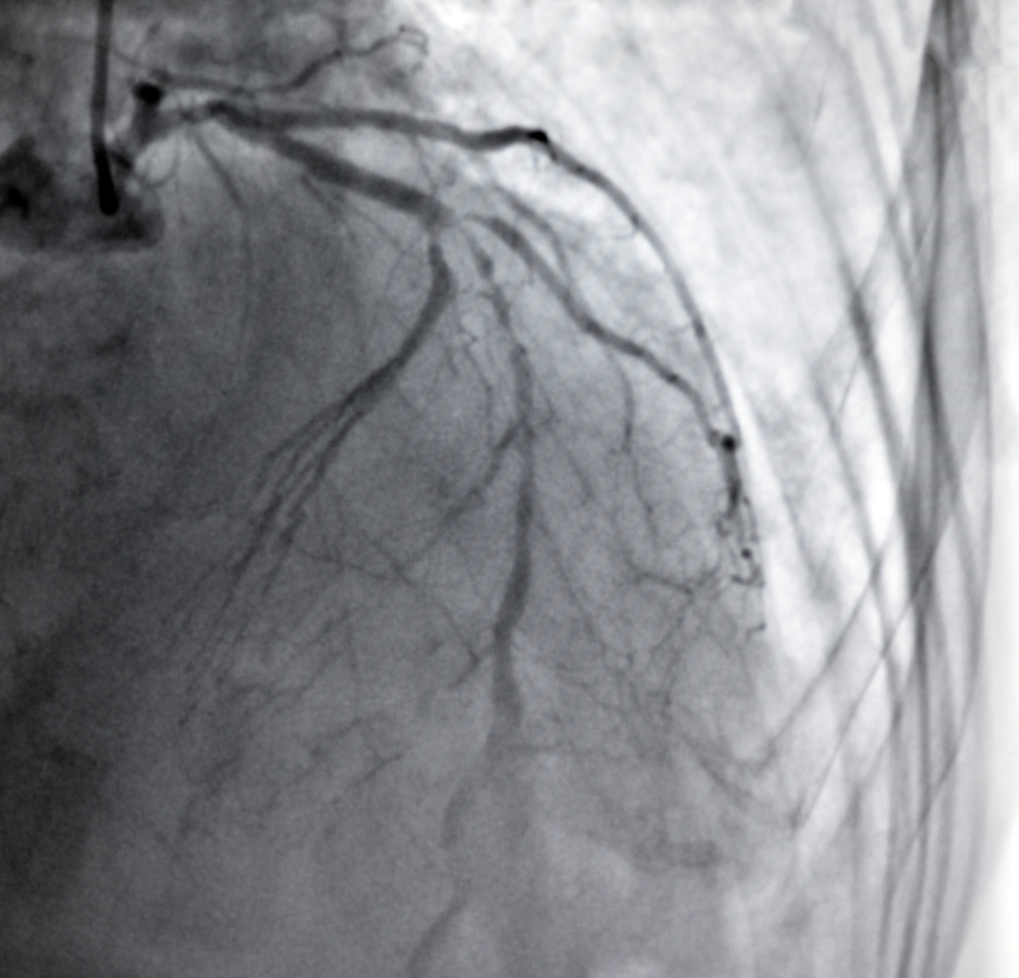 个别入球小动脉灶性透明变性 可以恢复吗