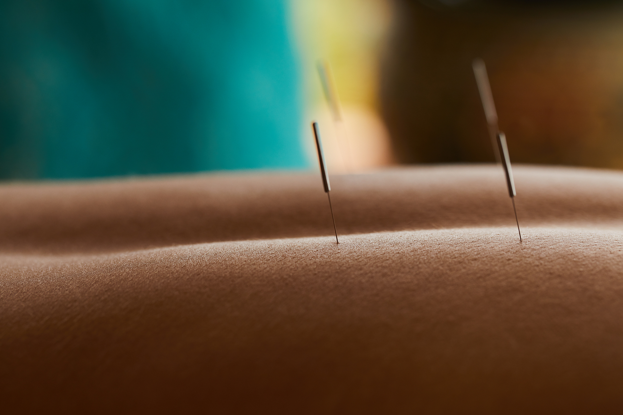woman getting acupuncture done on her back