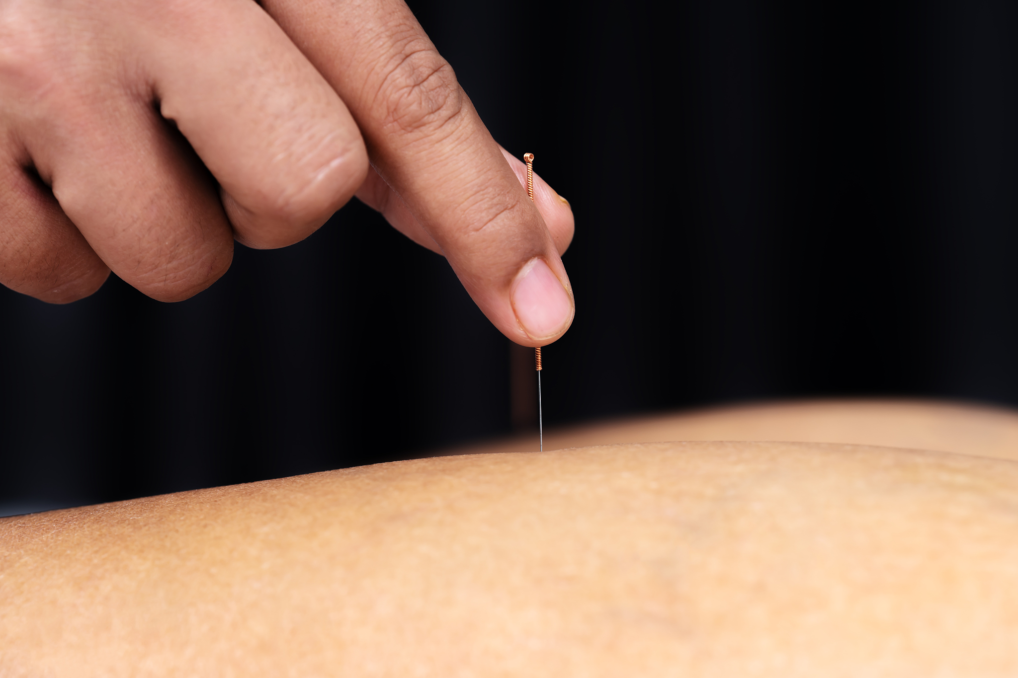 close-up of person getting acupuncture therapy