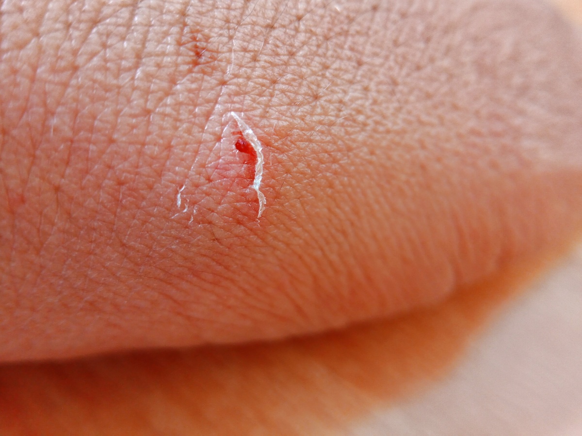 自己缝合伤口？危险！寻求专业帮助才能安全