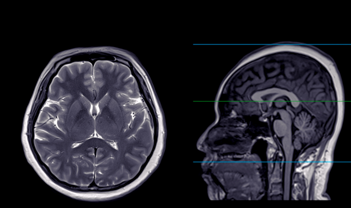 脑疝：症状、原因、治疗 - 权威解读