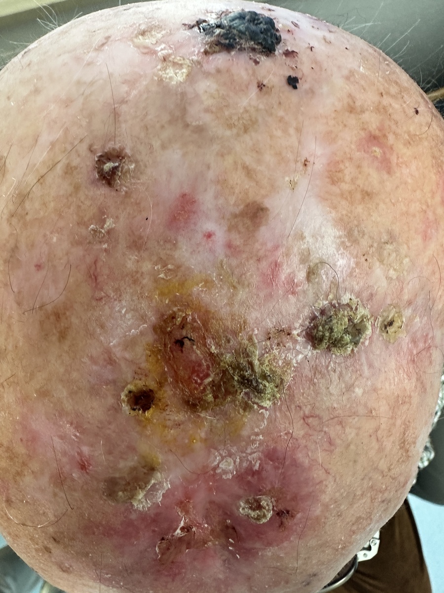 头顶视角,展示不同阶段的鳞状细胞癌