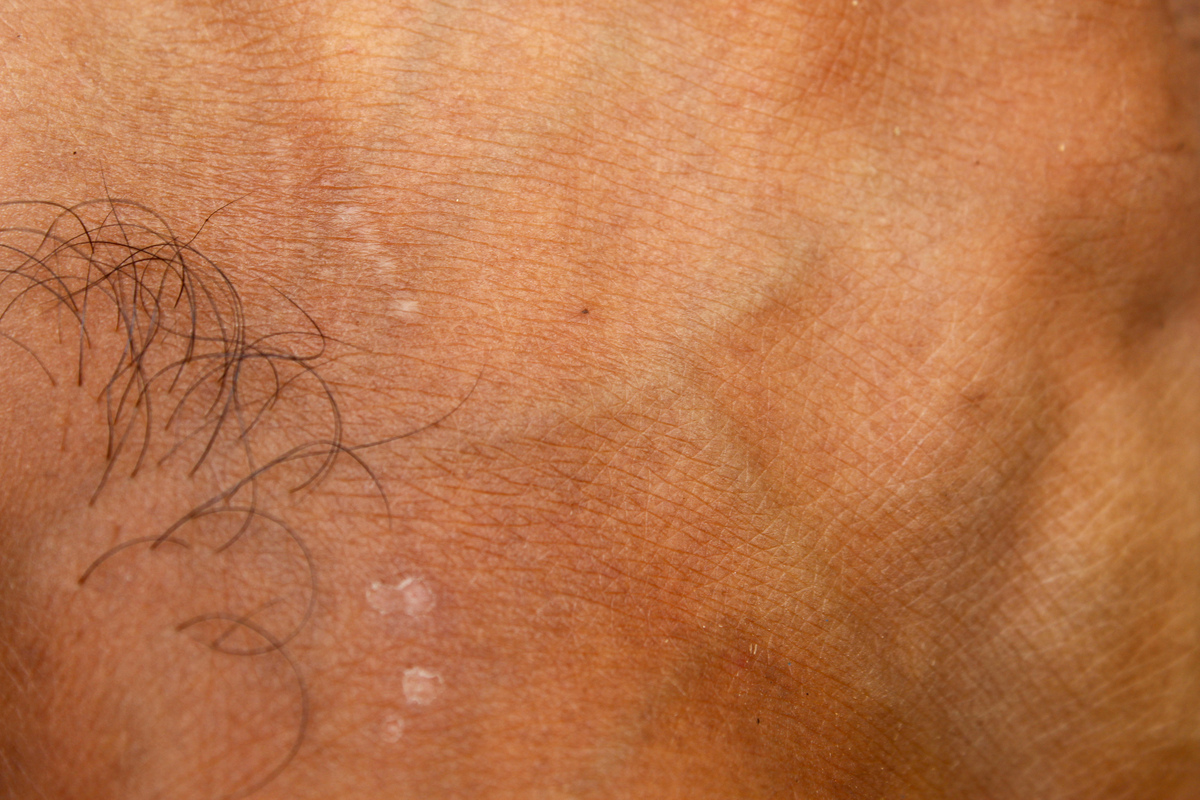 毛周角化病治疗方法：缓解红肿、疼痛和脓疱