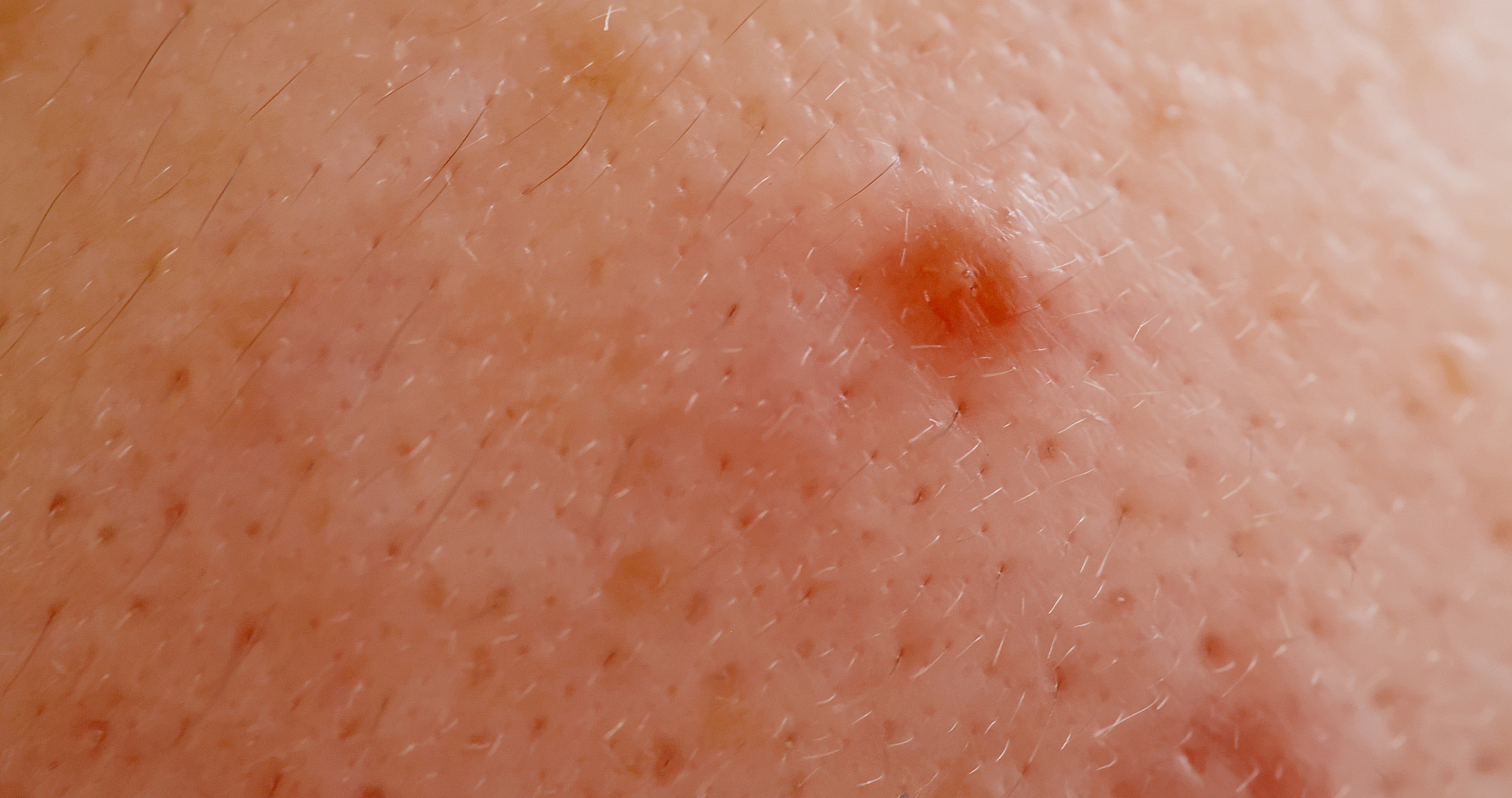acne on the woman face