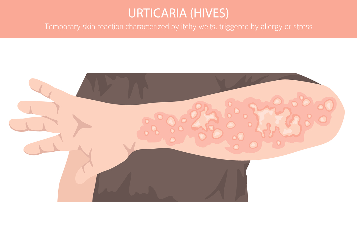 胆碱能性荨麻疹如何影响生活