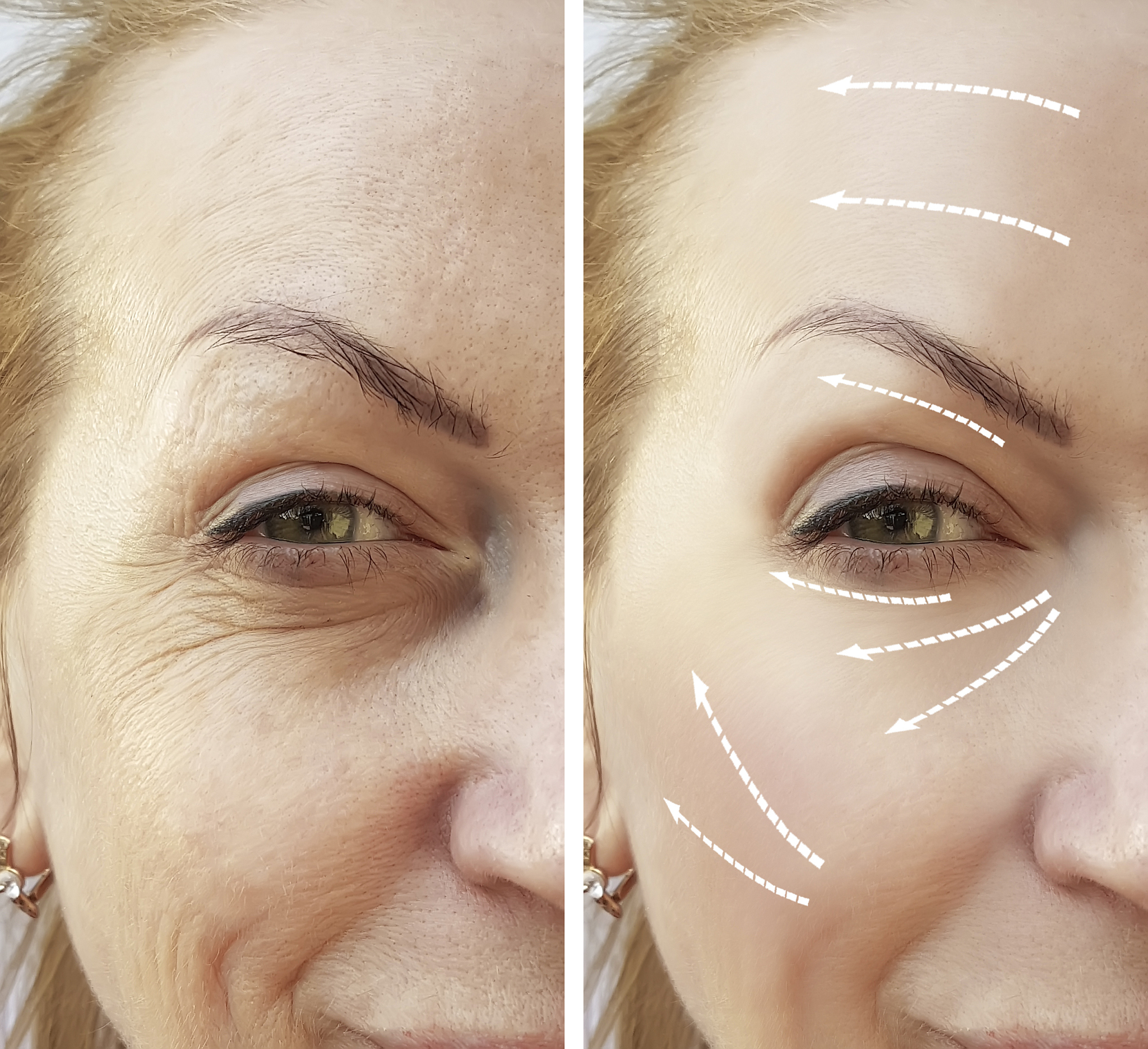 眼袋怎么办？有效缓解眼袋的方法