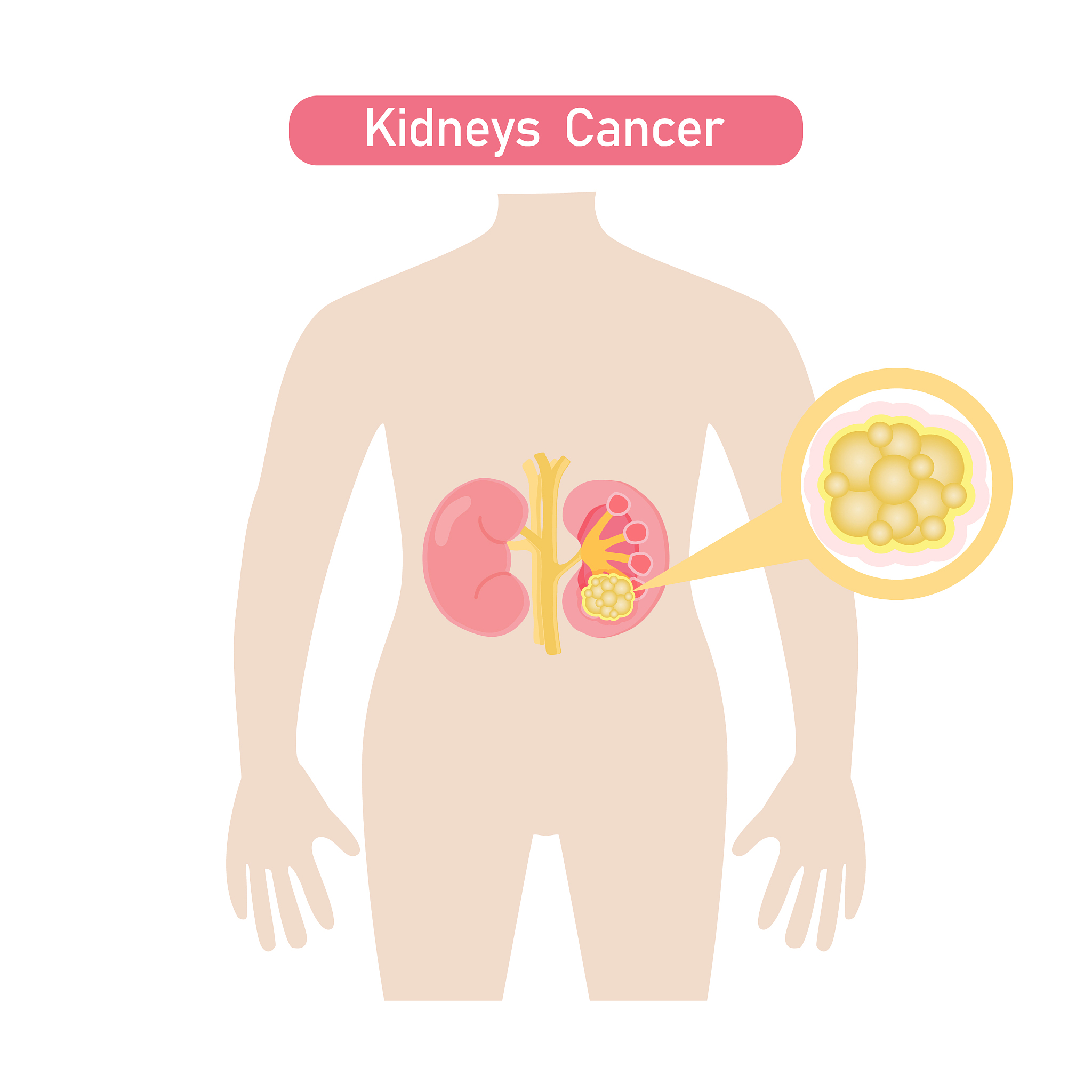 肾癌切除一个肾脏后应该注意什么
