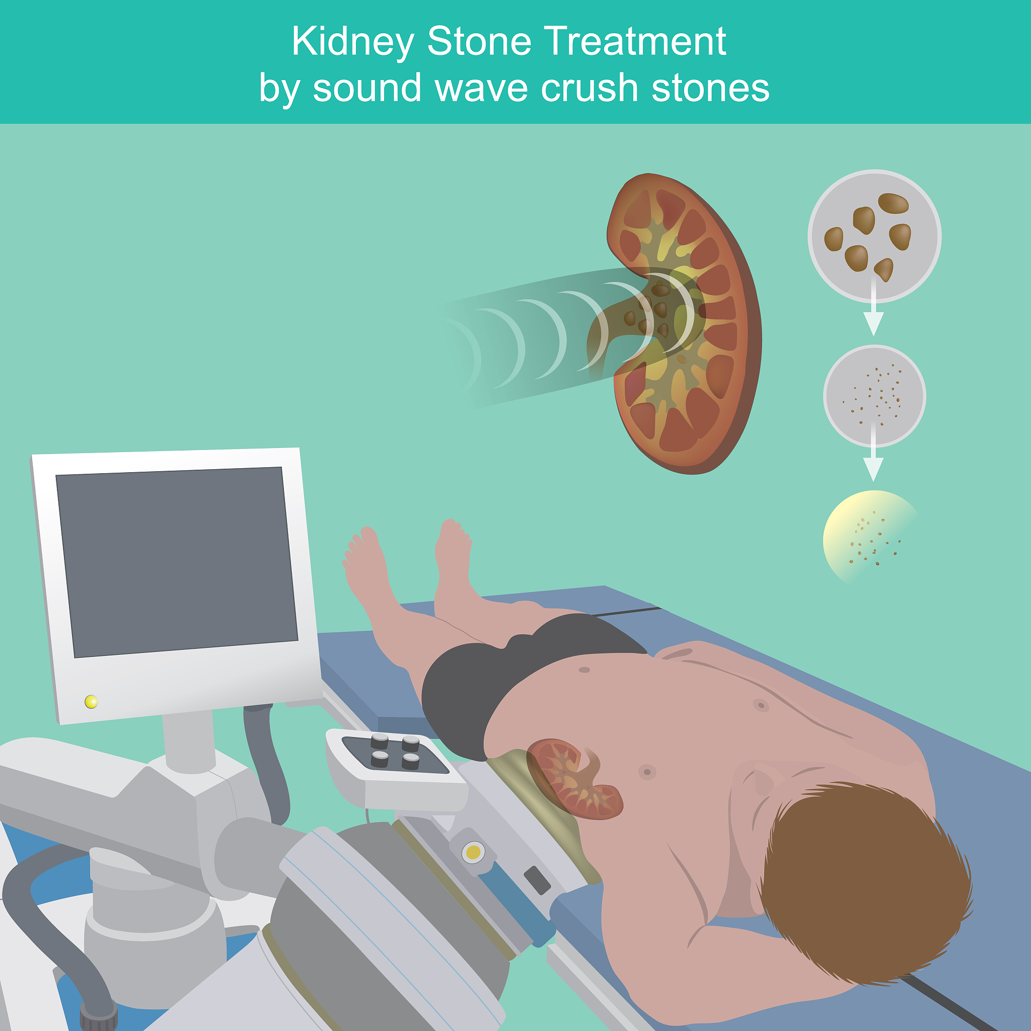 为什么有的人容易的结石