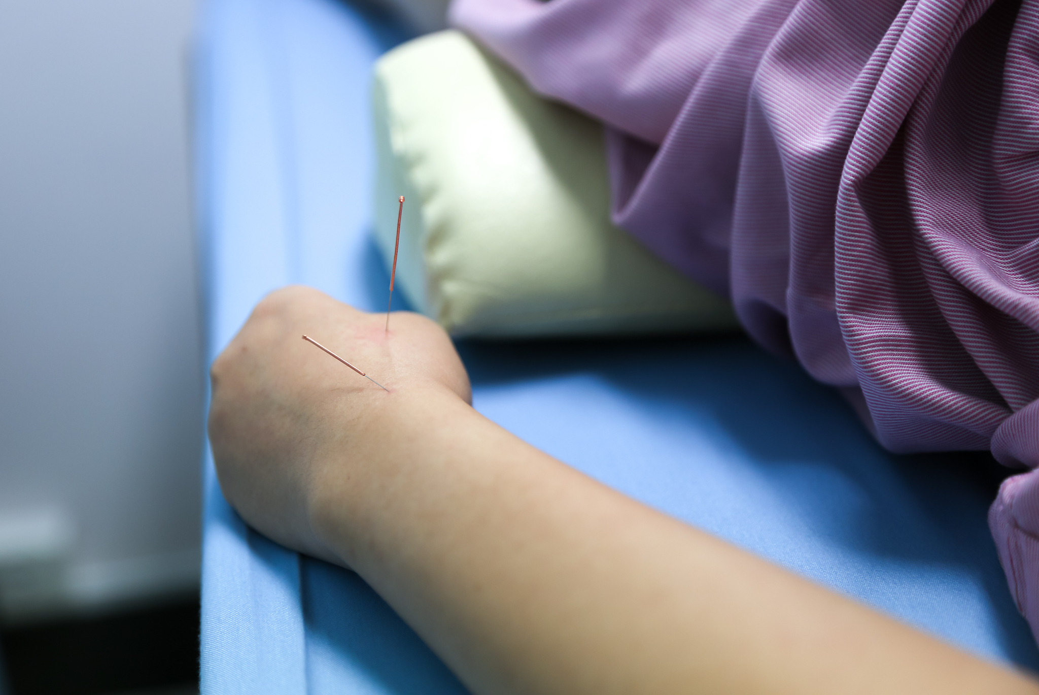 hand of a woman with acupuncture treatment