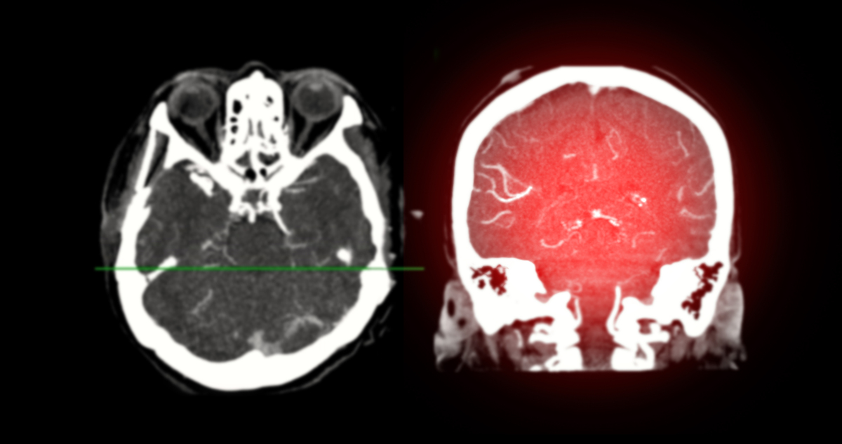右侧颈内动脉起始部中度狭窄伴漂浮血栓形成：DSA、CTA、MRA诊断
