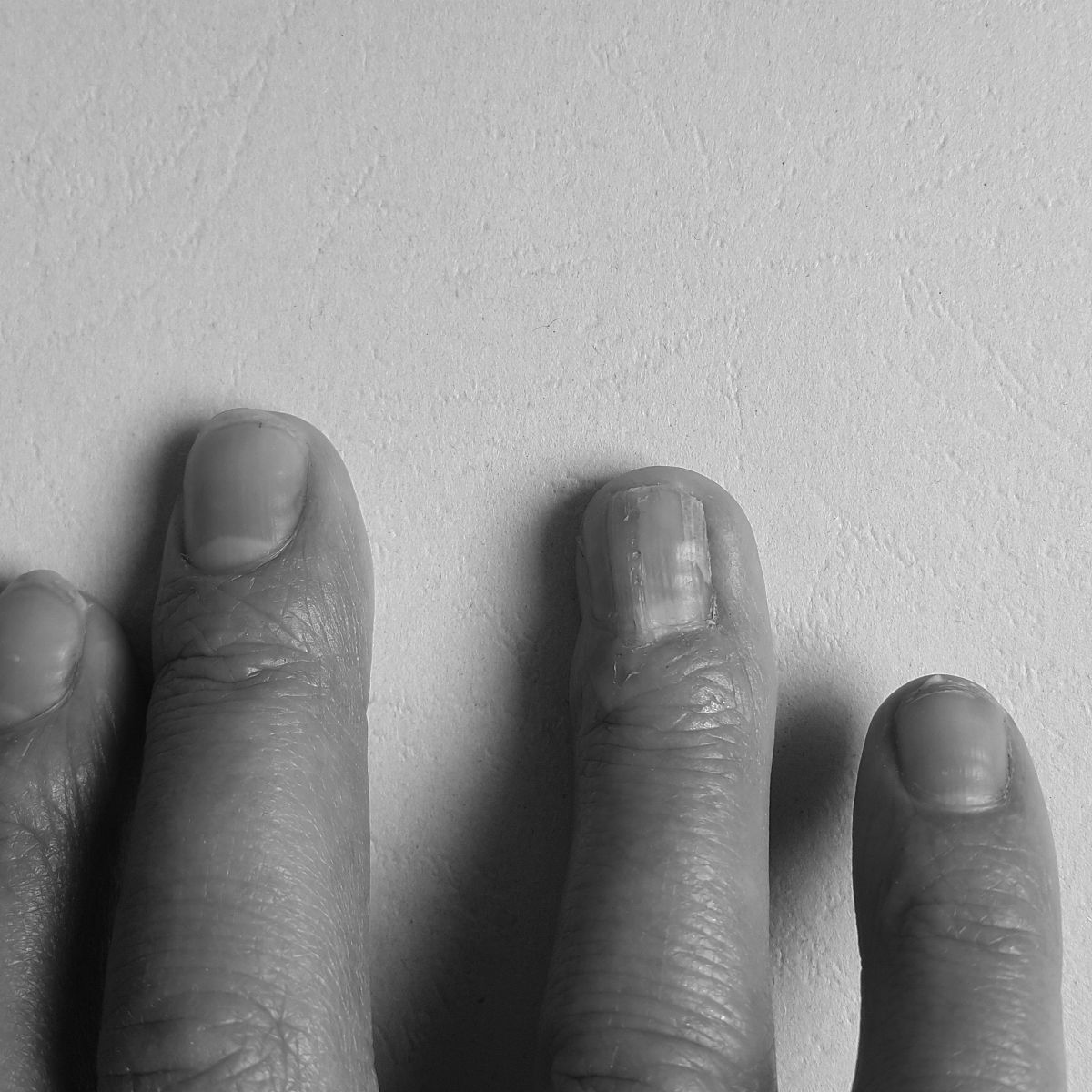 手指上的月牙突然没有了是怎么回事？