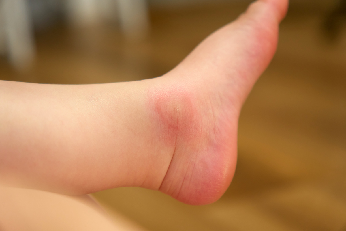 我今年20岁女每次被蚊子都会起一个很大很硬的包别人则不会。是什么原因