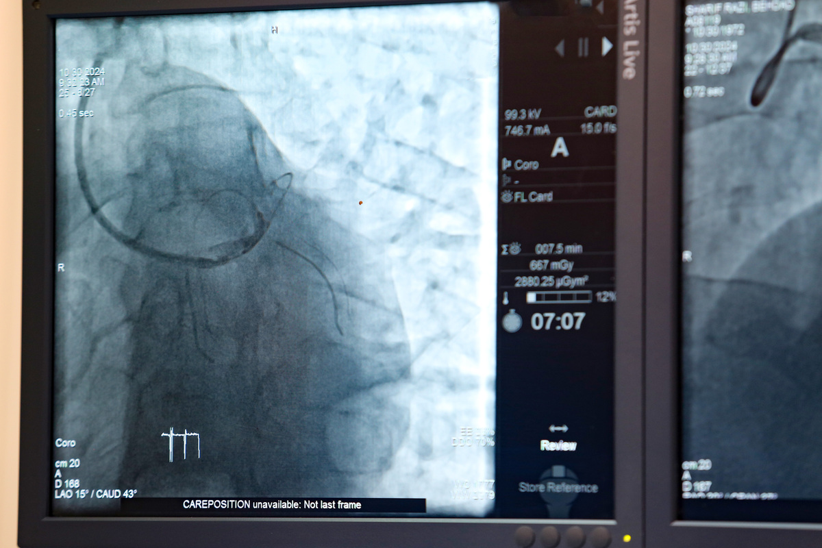 超声造影：什么是超声造影以及它的应用？
