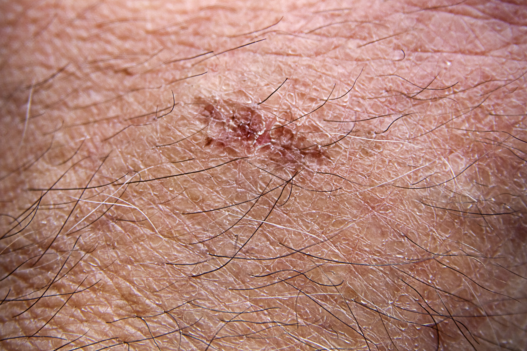 healing burn on skin