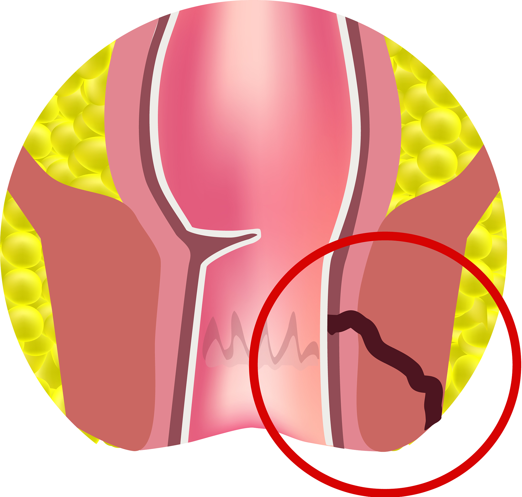 types of fistulas of the rectum paraproctitis