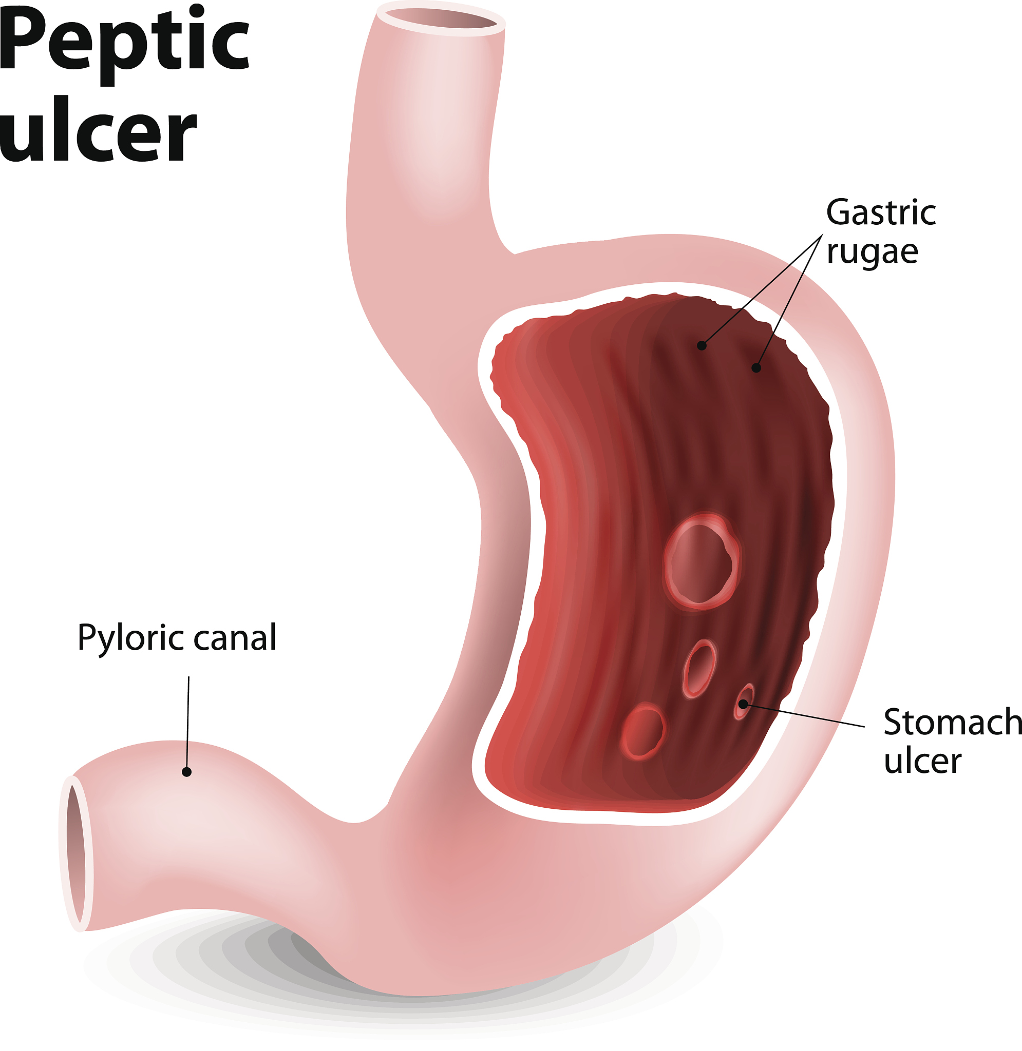 十二指肠溃疡严重吗