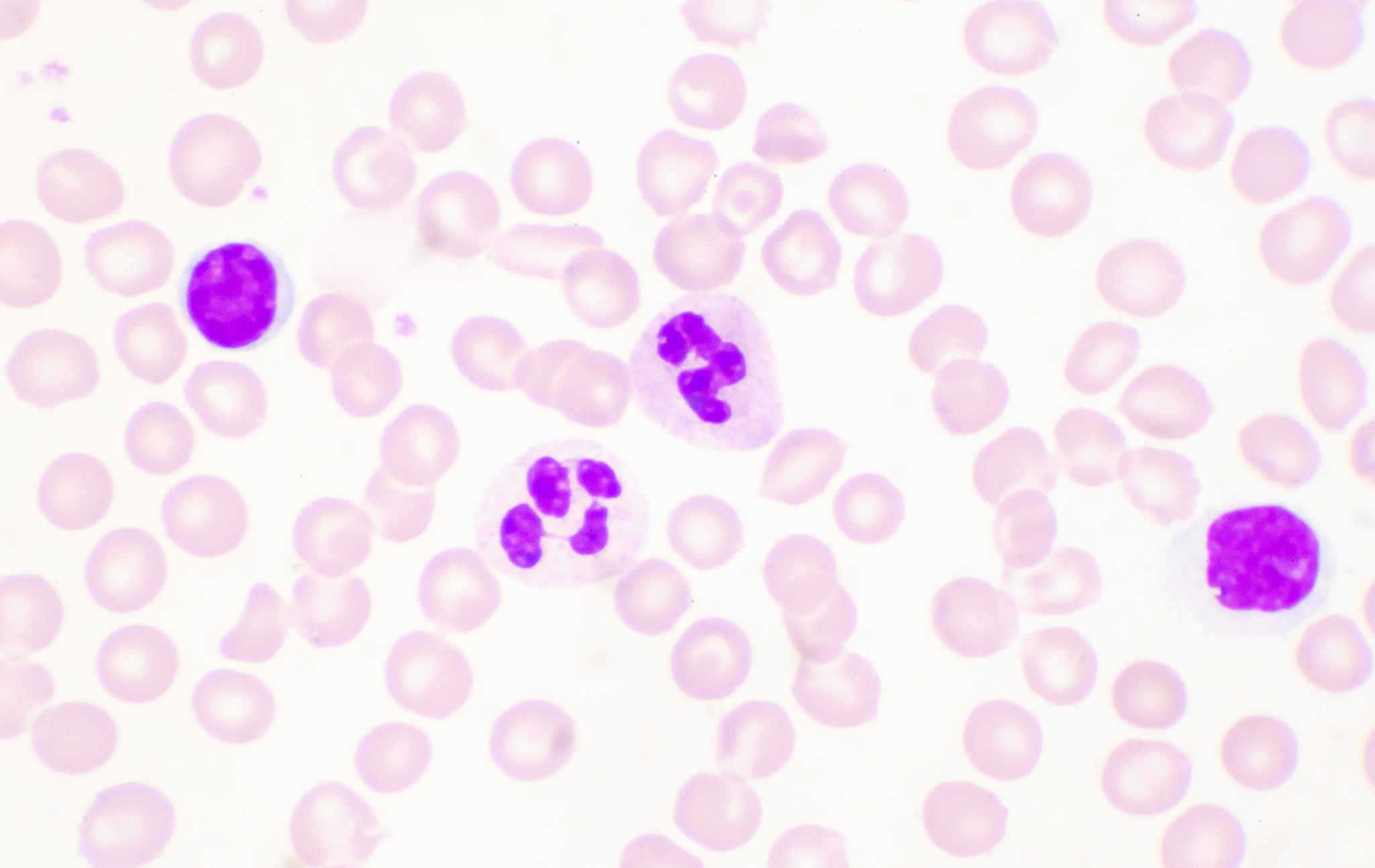 淋巴亚群在血液肿瘤中的应用：分期、预后评估和治疗 - 血液肿瘤诊断治疗新方向